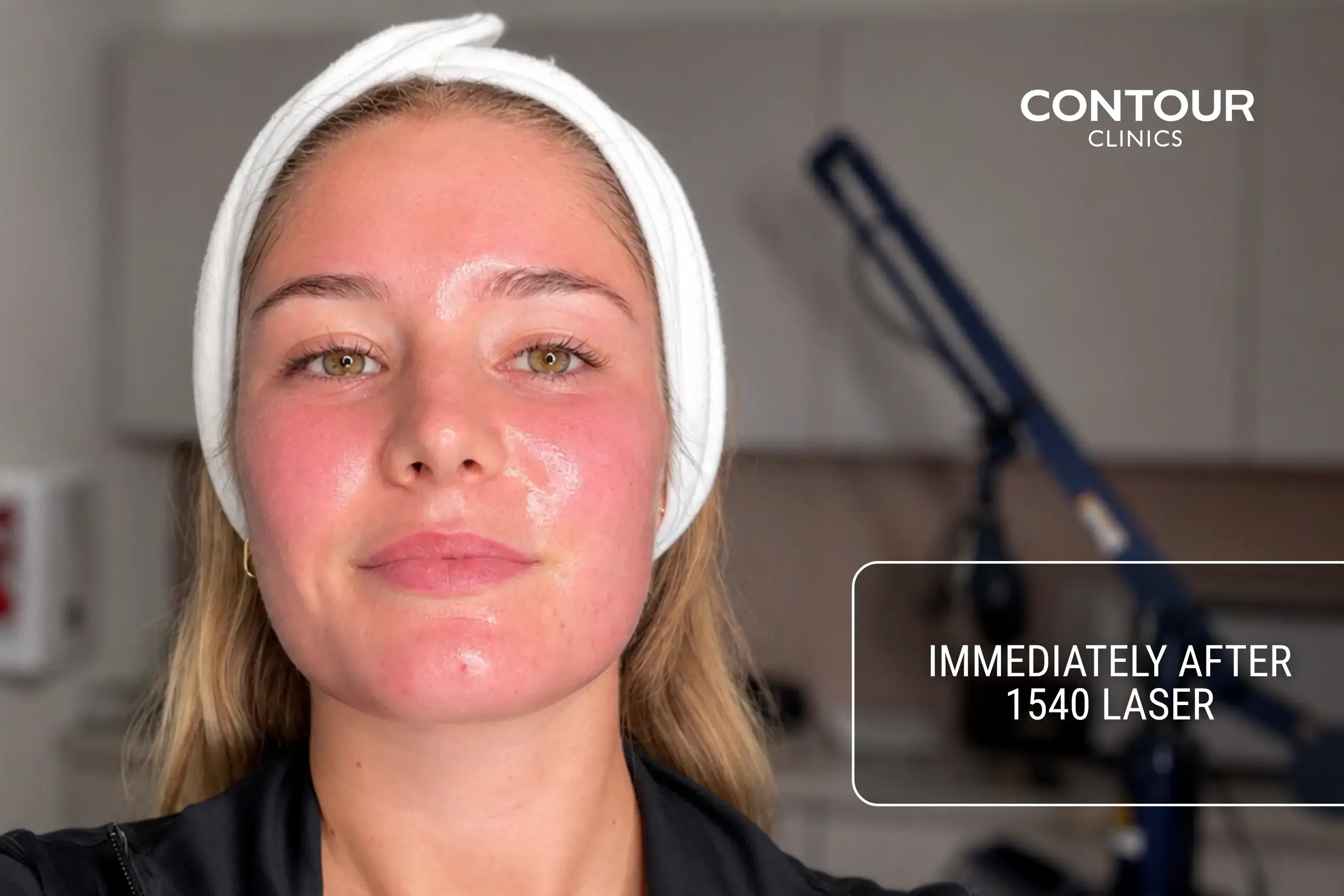 How skin looks immediately after 1540 fractional laser