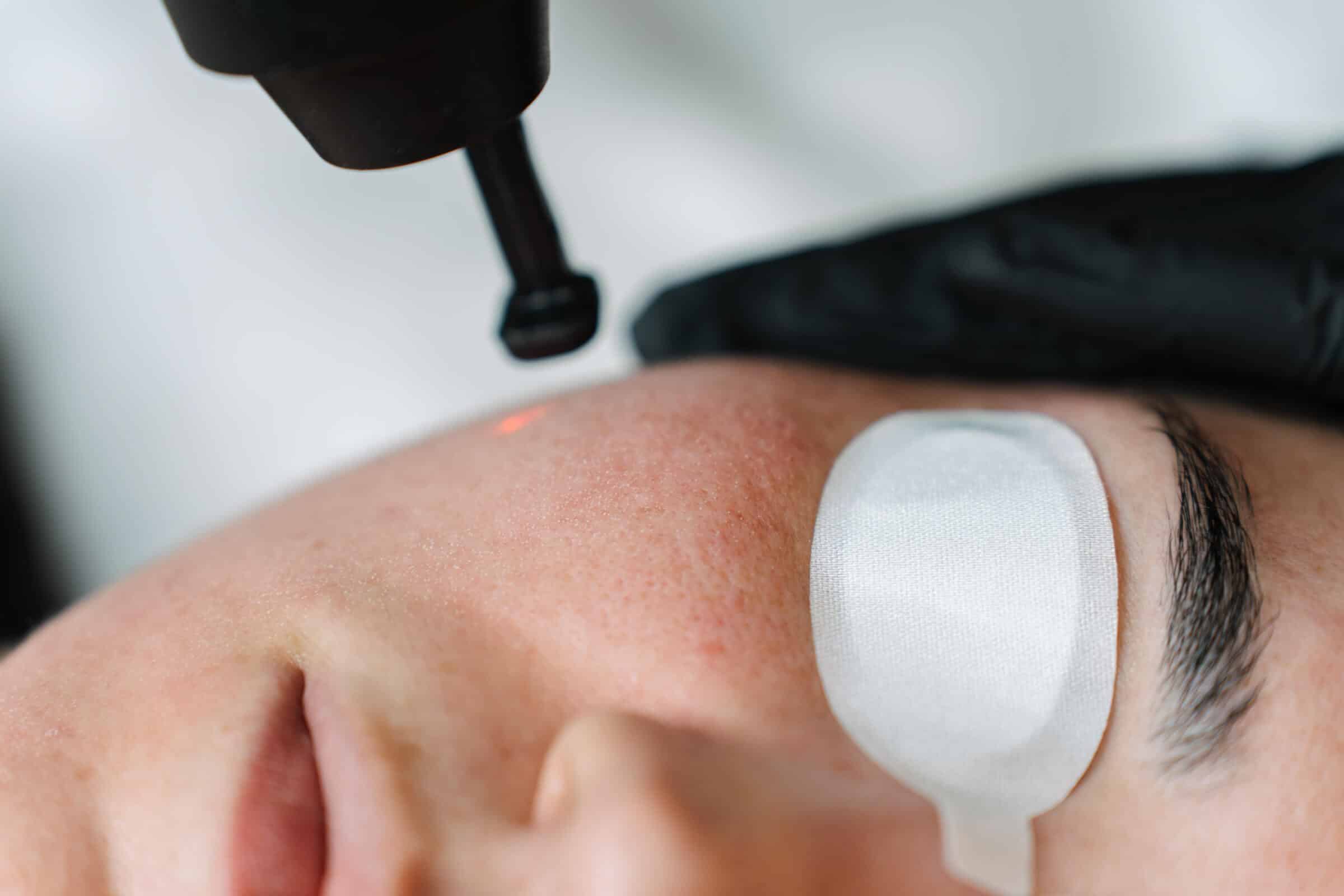 How Co2 Fractional Laser Works - explained by cosmetic doctors at Contour Clinics