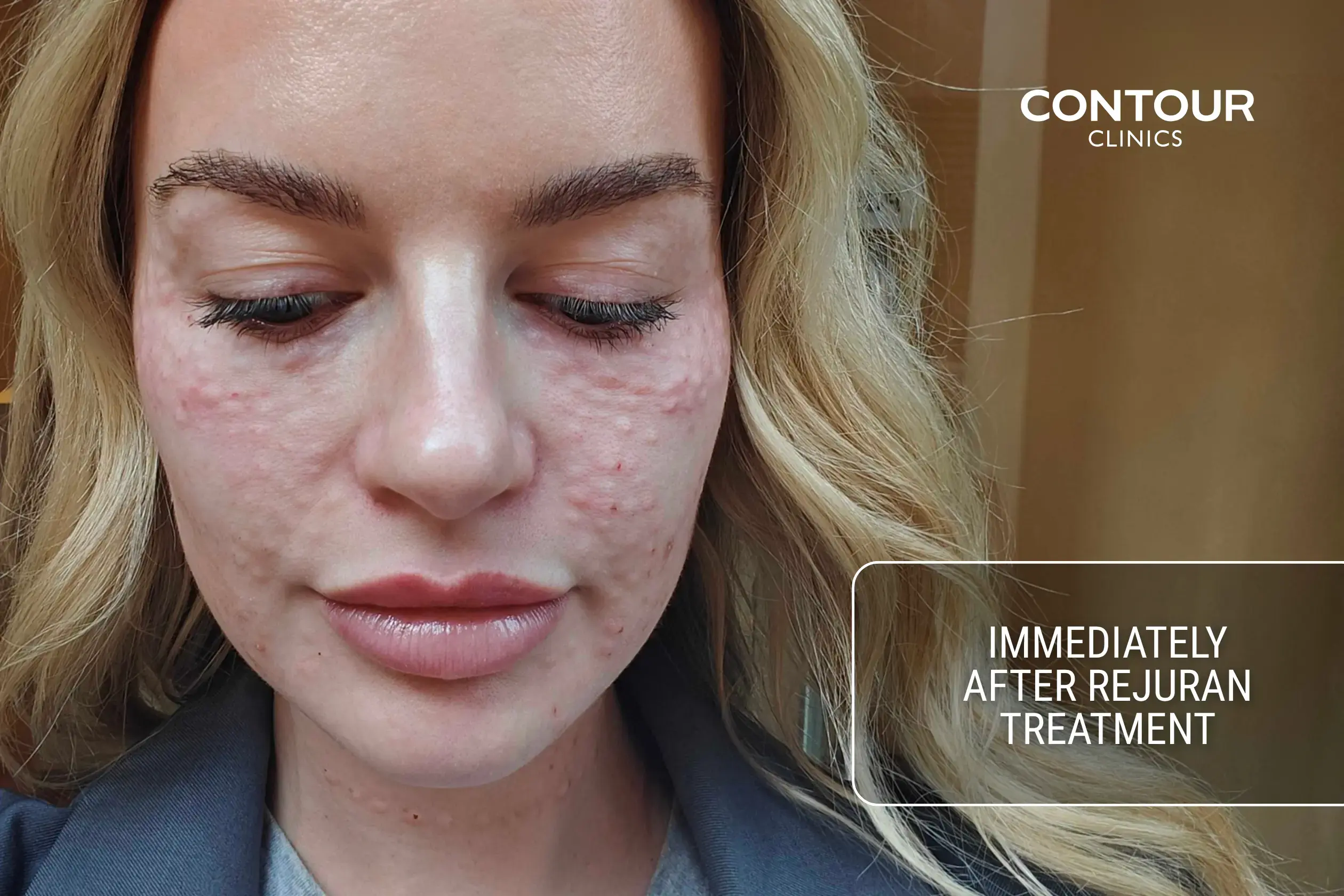 Rejuran recovery post-treatment