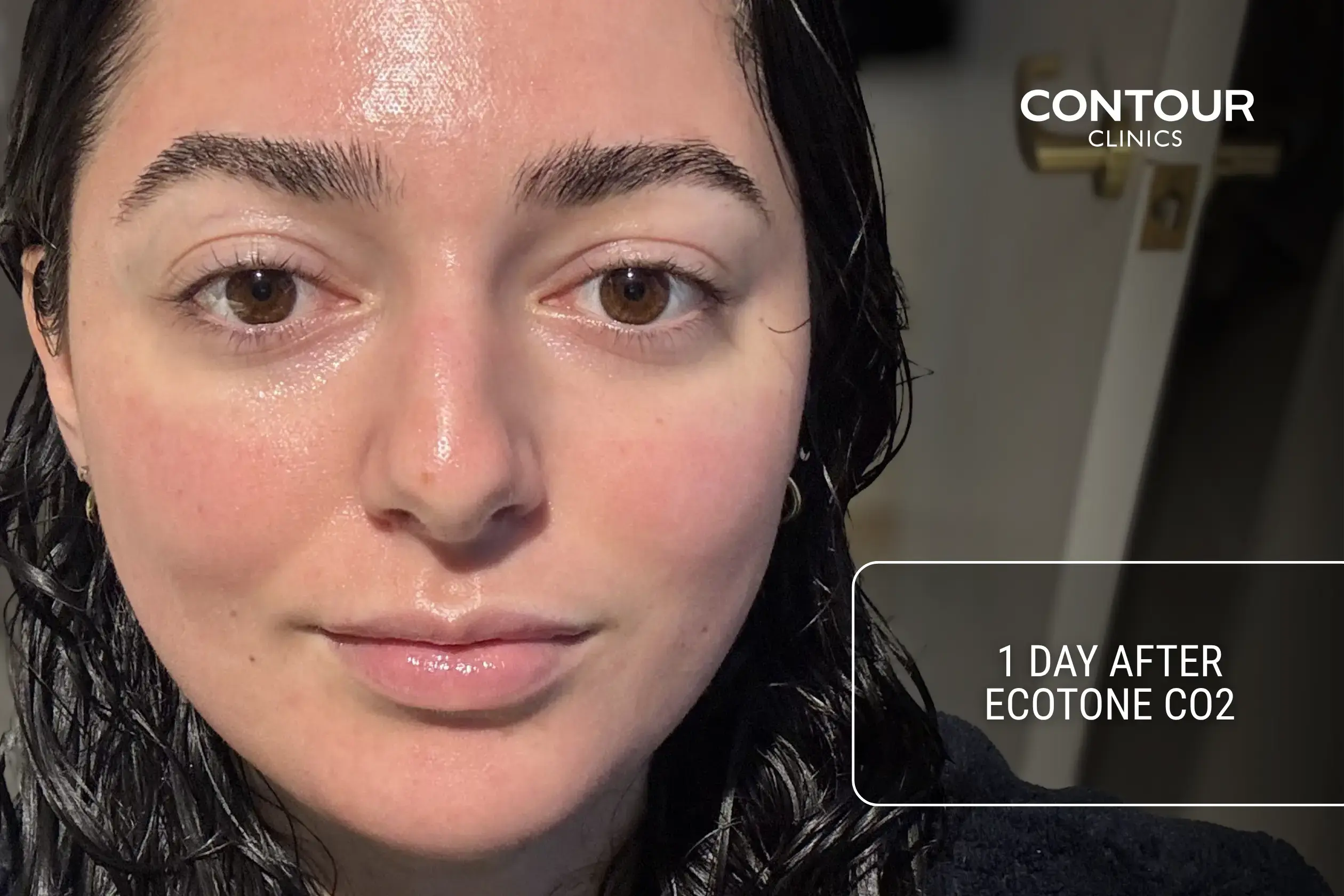 What Co2 Ecotone laser recovery looks like 1 day after treatment