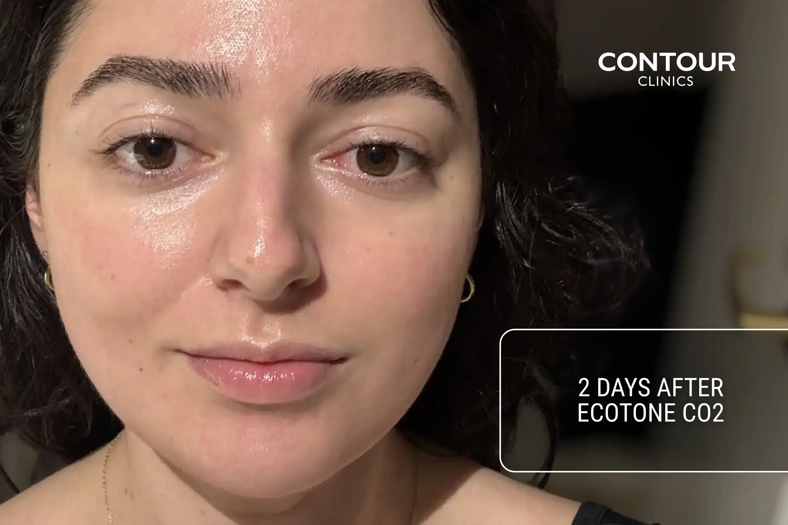 What Co2 Ecotone laser recovery looks like 2 days after treatment