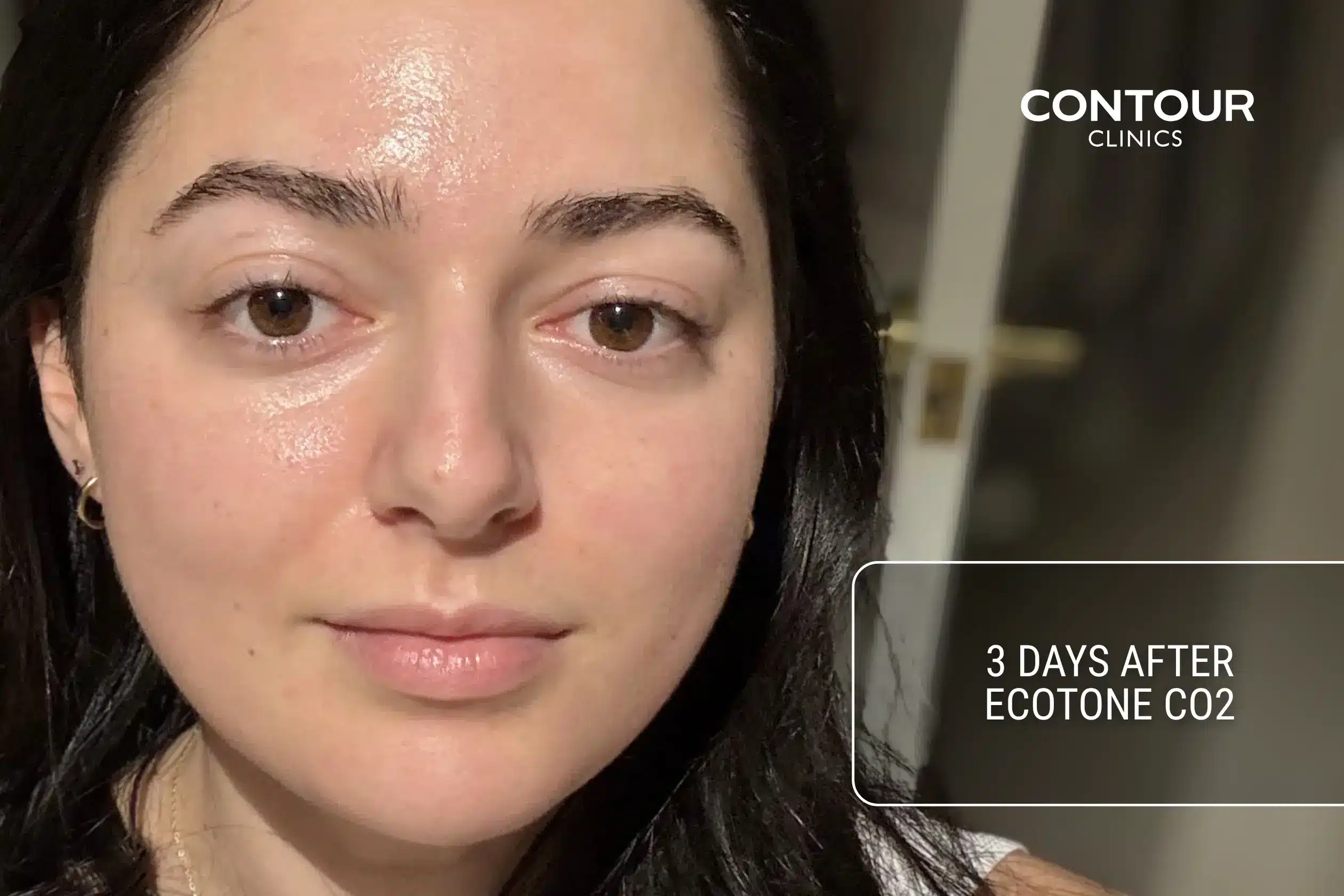 What Co2 Ecotone laser recovery looks like 3 days after treatment