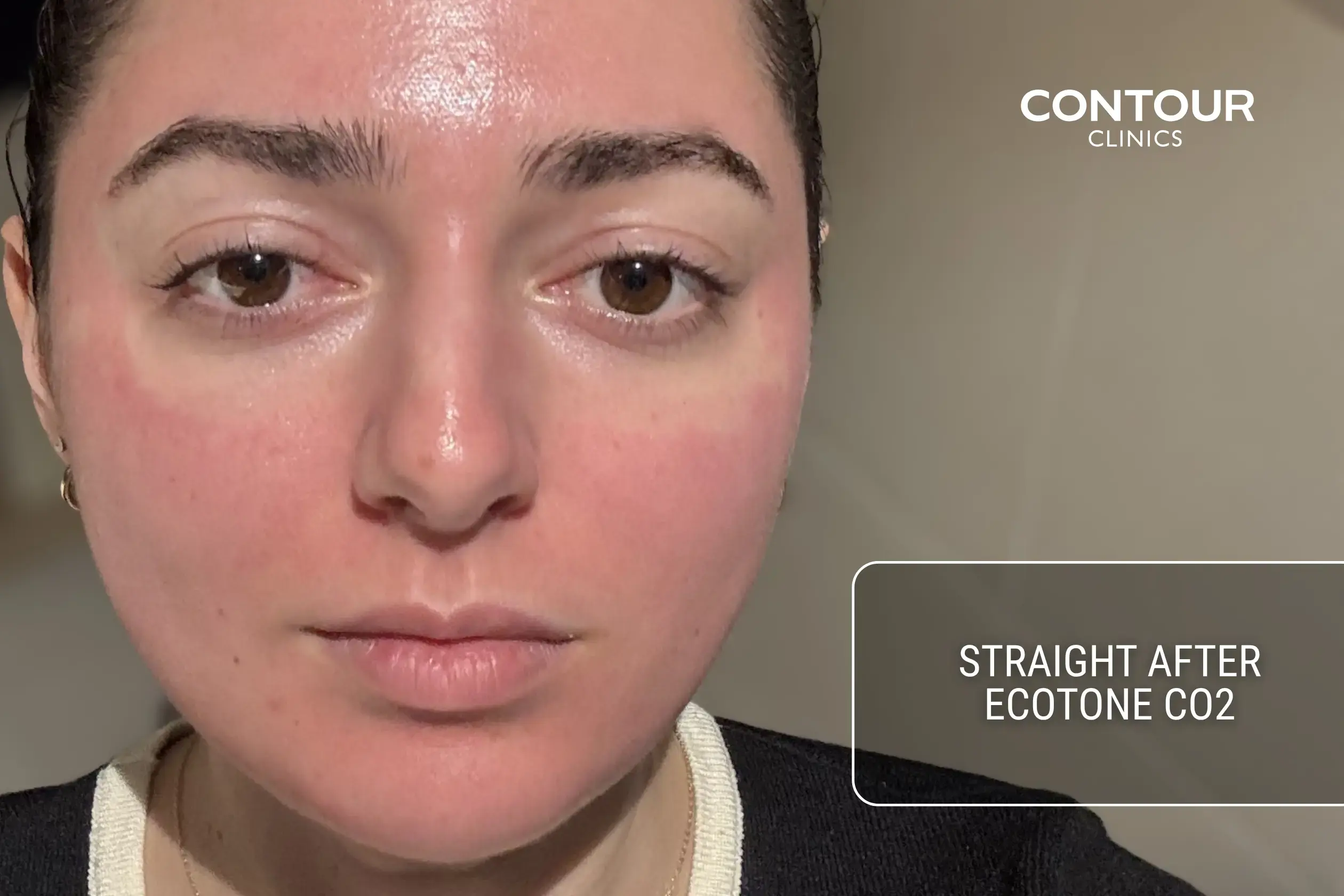 What Co2 Ecotone laser recovery looks like immediately after treatment