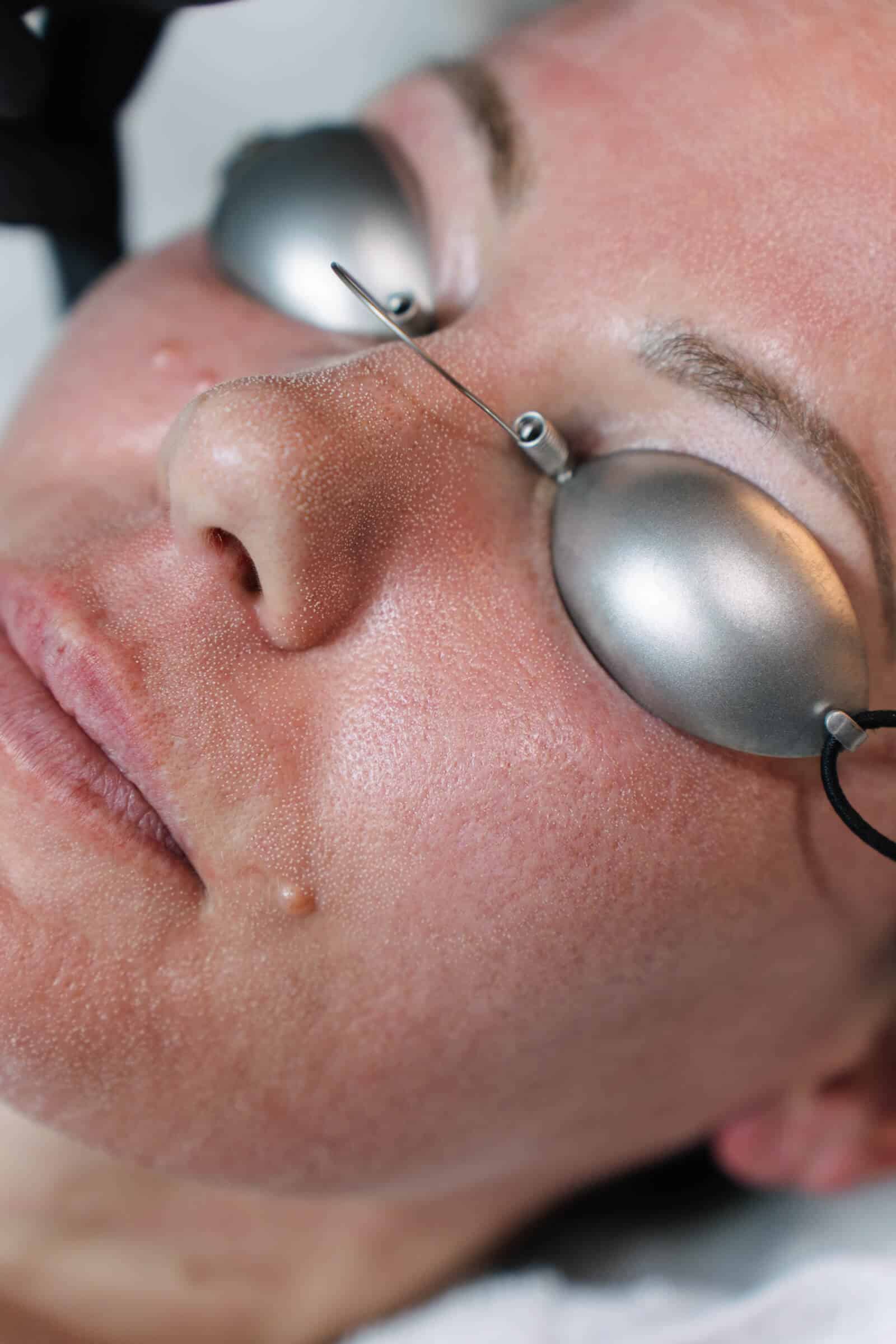Close up image showing a woman's face during Co2 laser skin treatment at Contour Clinics