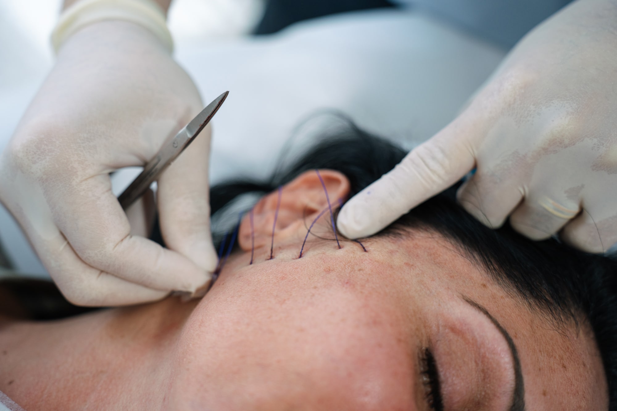 Facial thread lifting tighten sagging jowls at Contour Clinics Sydney and Brisbane