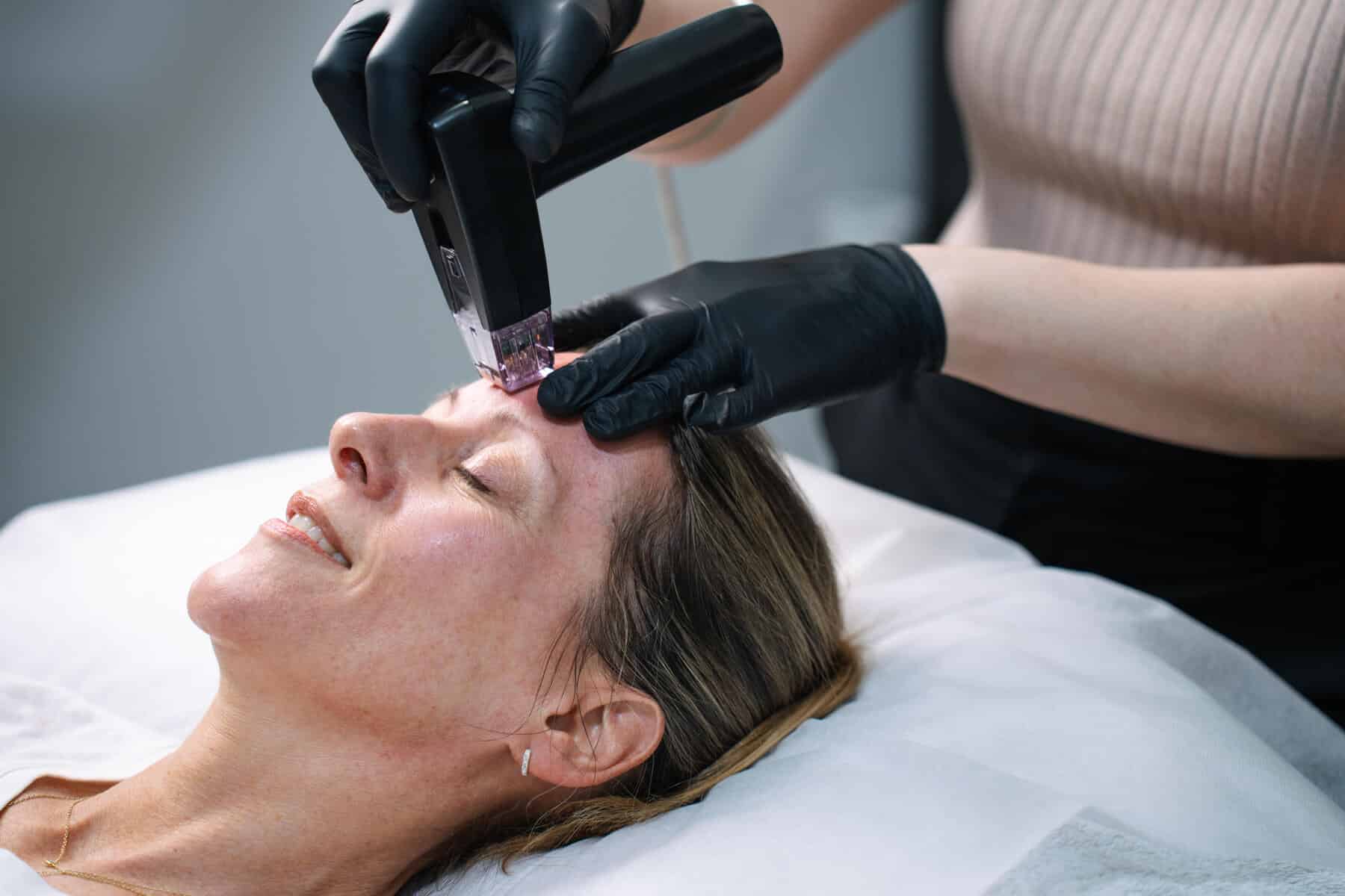 Skin needling treatment for mature skin