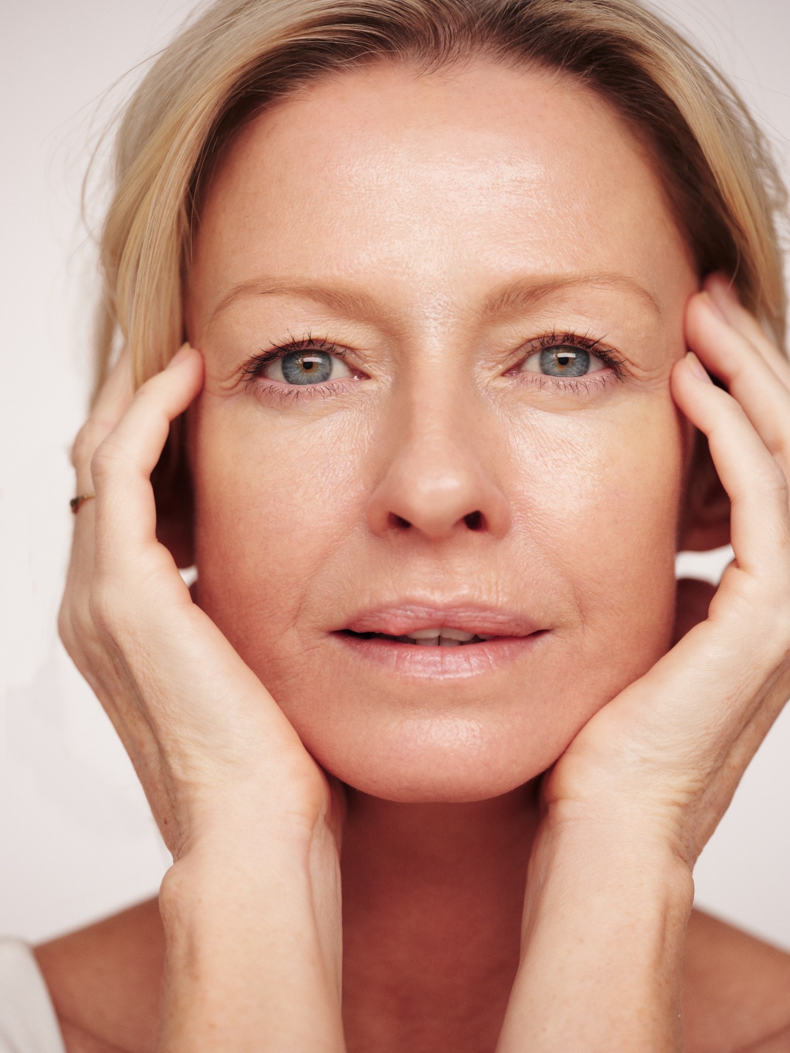 Marionette lines dermal filler
