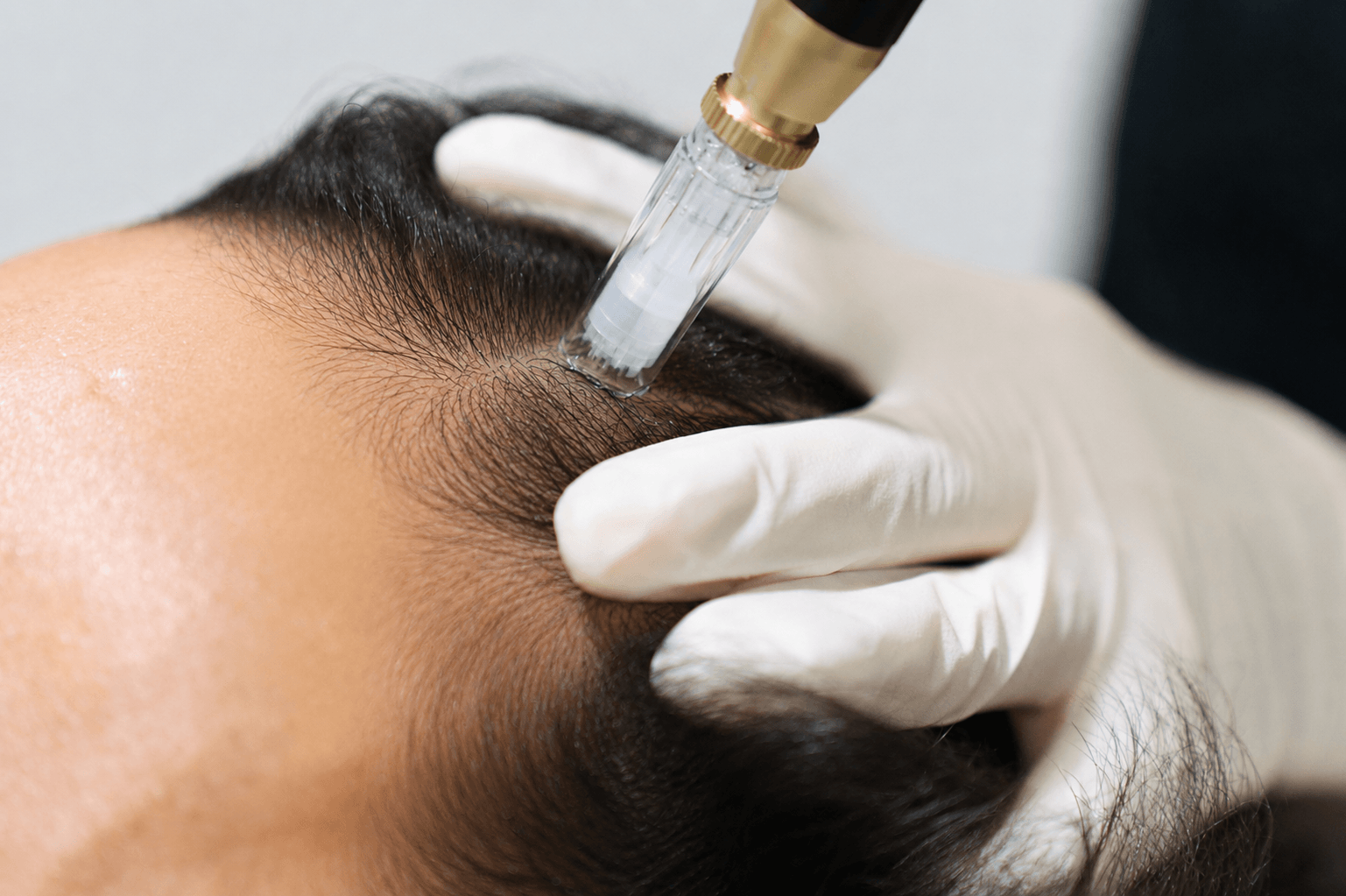 Microneedling with exosomes for hair loss treatment for women