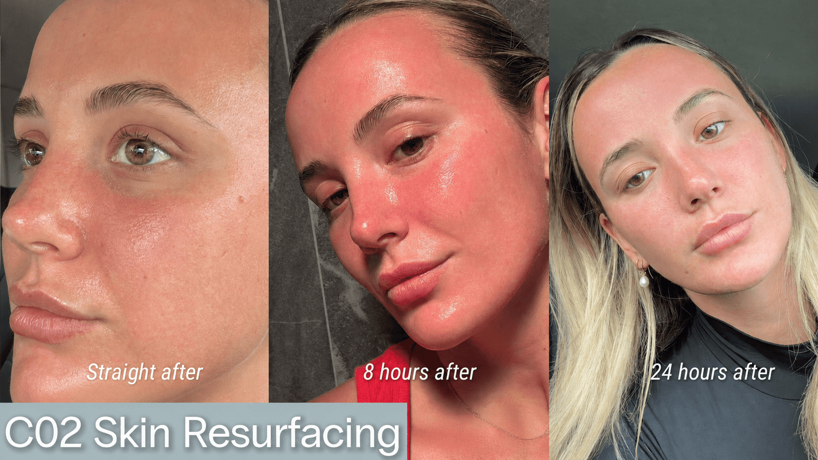 Co2 laser recovery timeline with patient photos - showing results to a woman's face straight after treatment, 8 hours after and 24 hours after