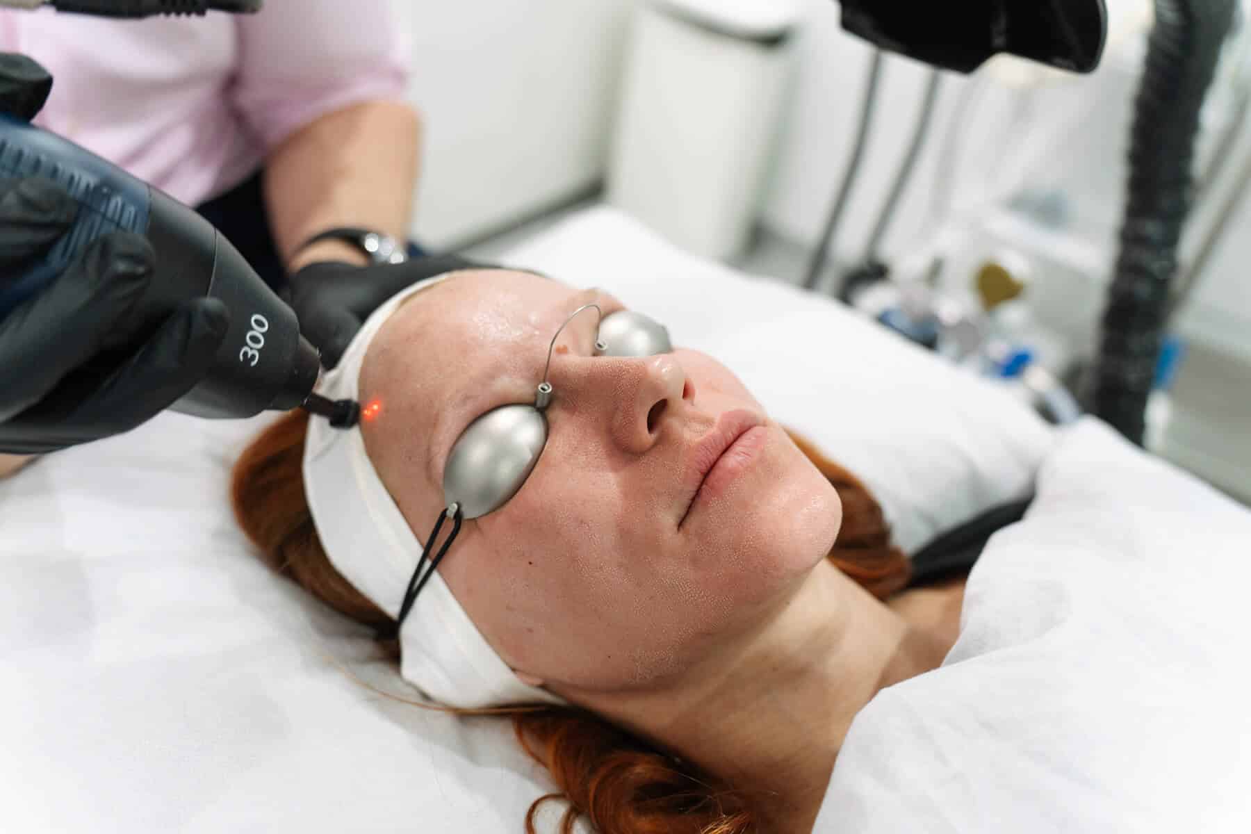 How Co2 Resurfacing Laser works