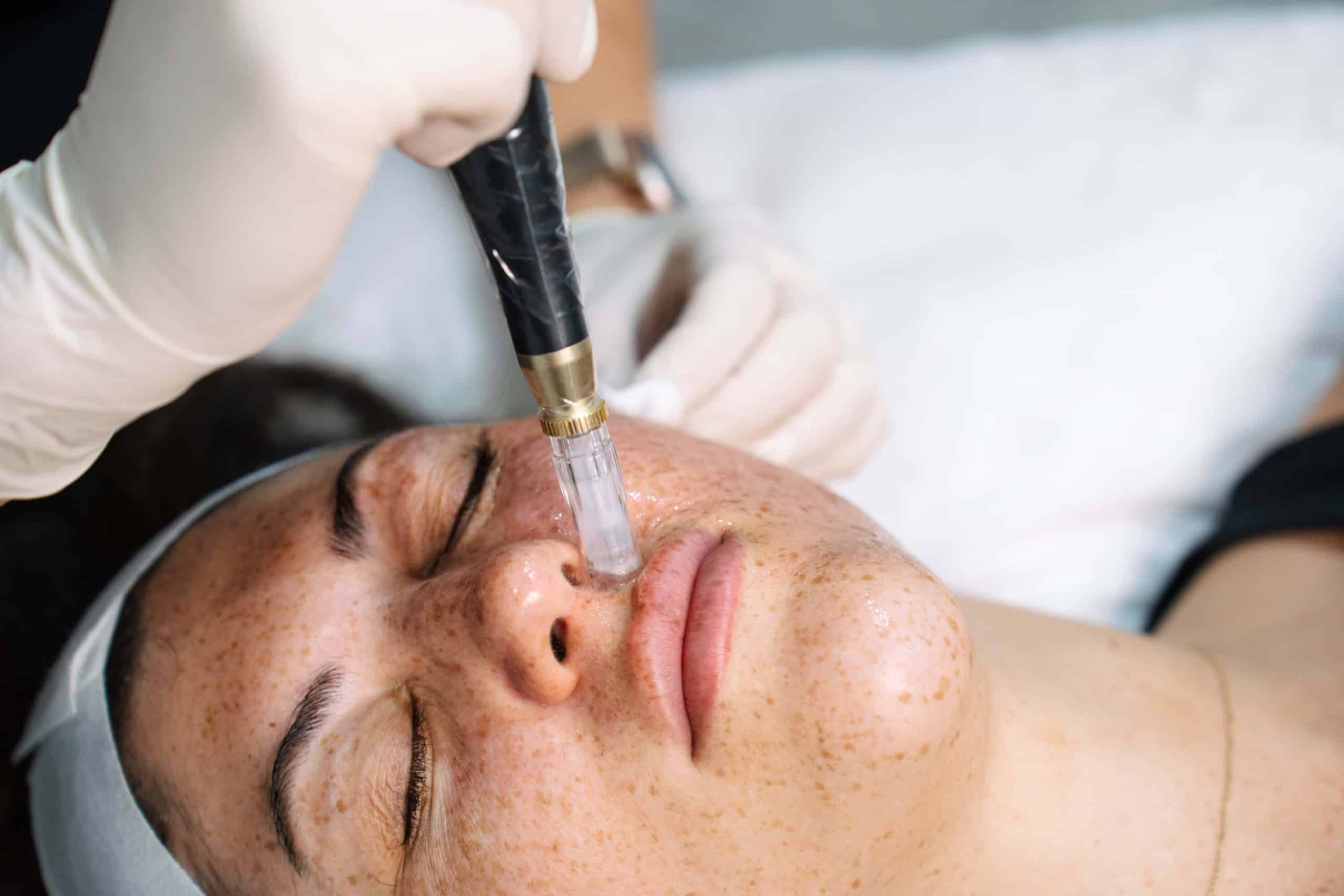 How laser treatment can improve skin clarity
