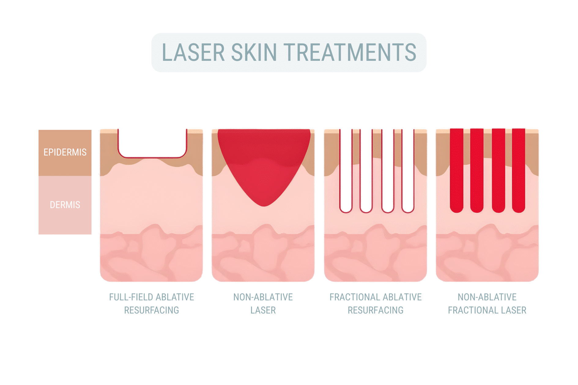 Graphic showing depth of penetration for laser skin resurfacing for ablative vs non ablative laser