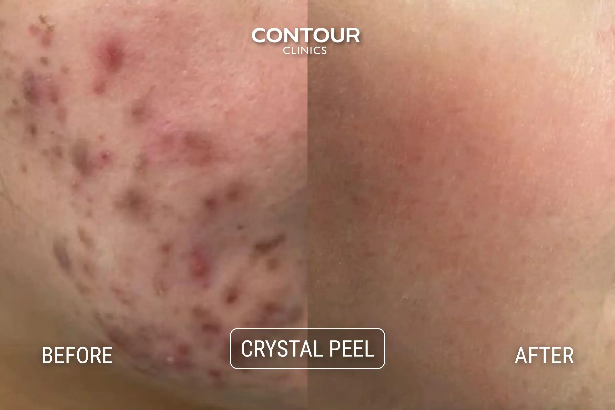 Before and After Crystal Peel for facial pigmentation at Contour Clinics