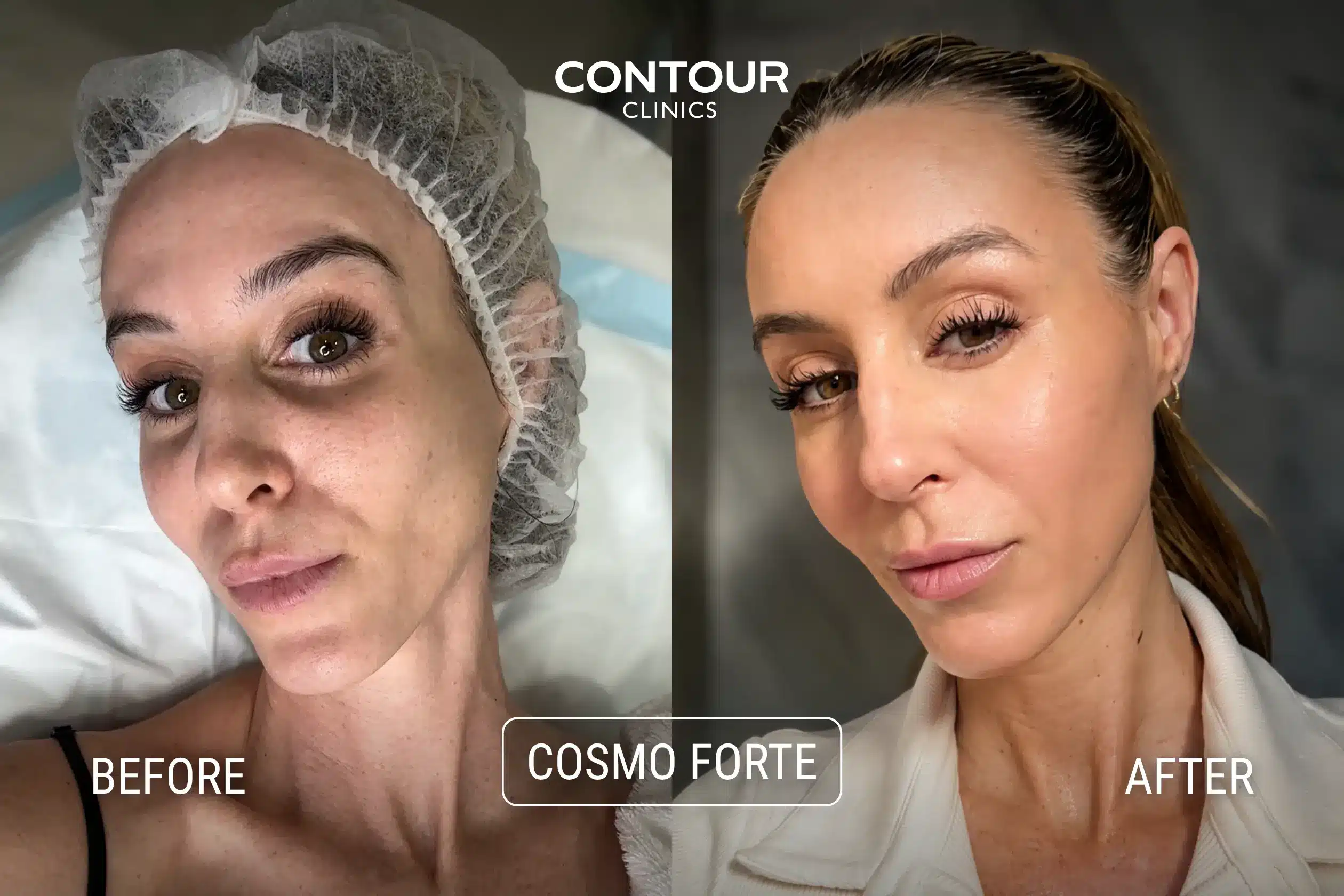 Before and After a TCA Chemical Peel (Cosmo Peel) for sun damaged skin