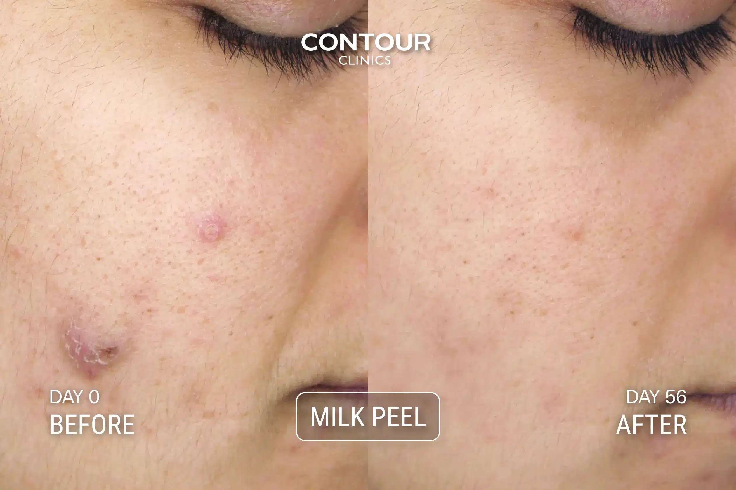 Before and after Milk Peel for congested, pigmented skin