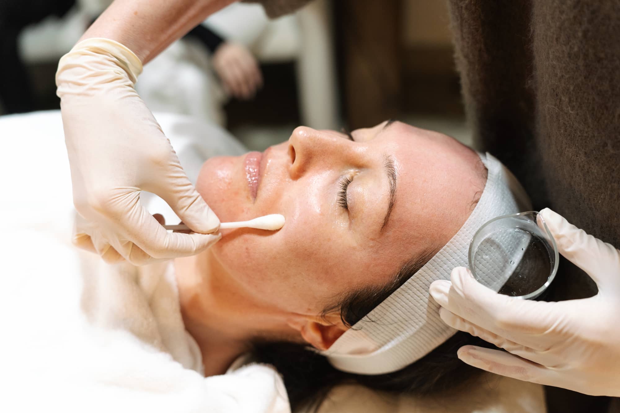 Chemical peel for pigmentation in Sydney and Brisbane at Contour Clinics