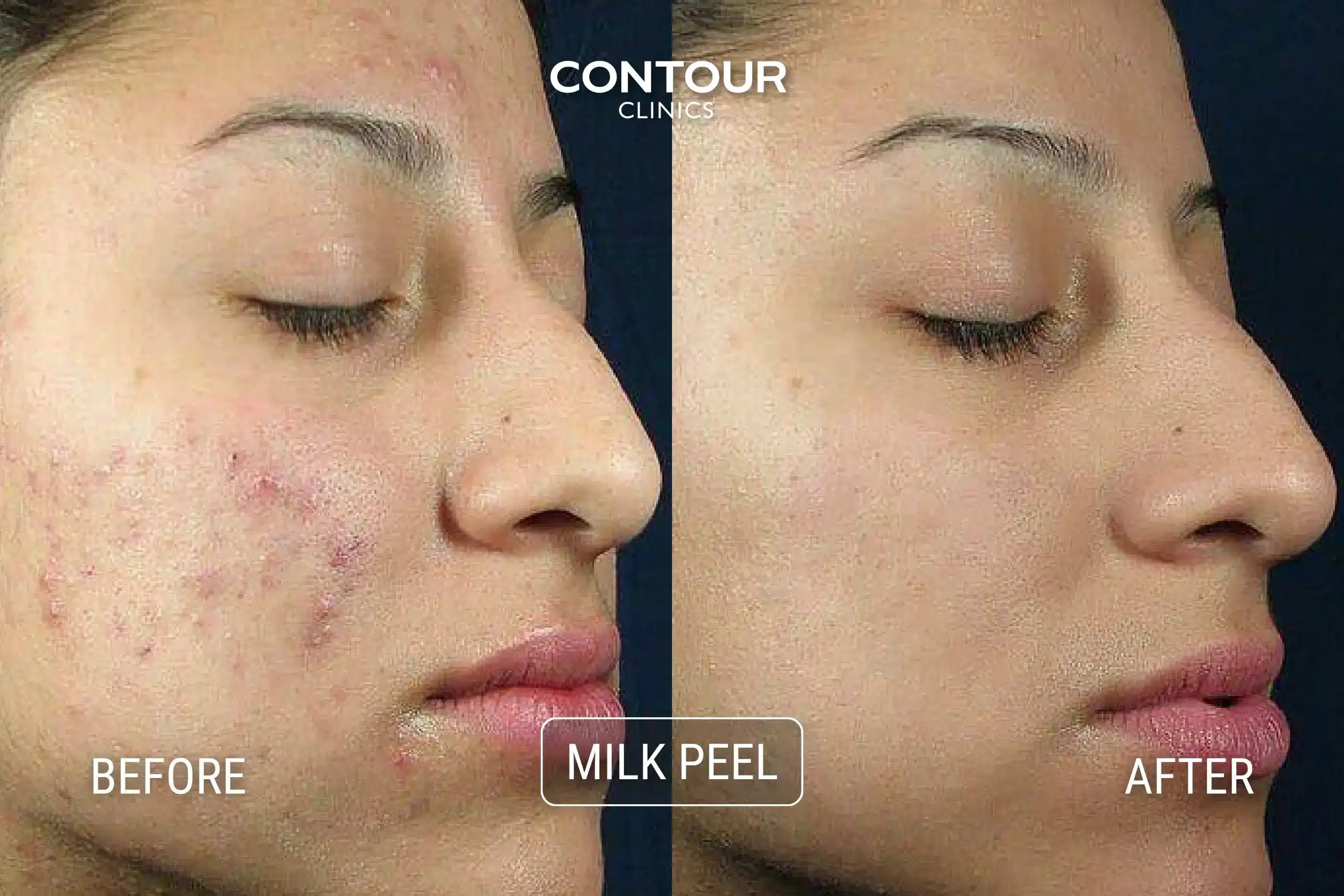 Female face showing clear skin after a Milk Peel at Contour Clinics
