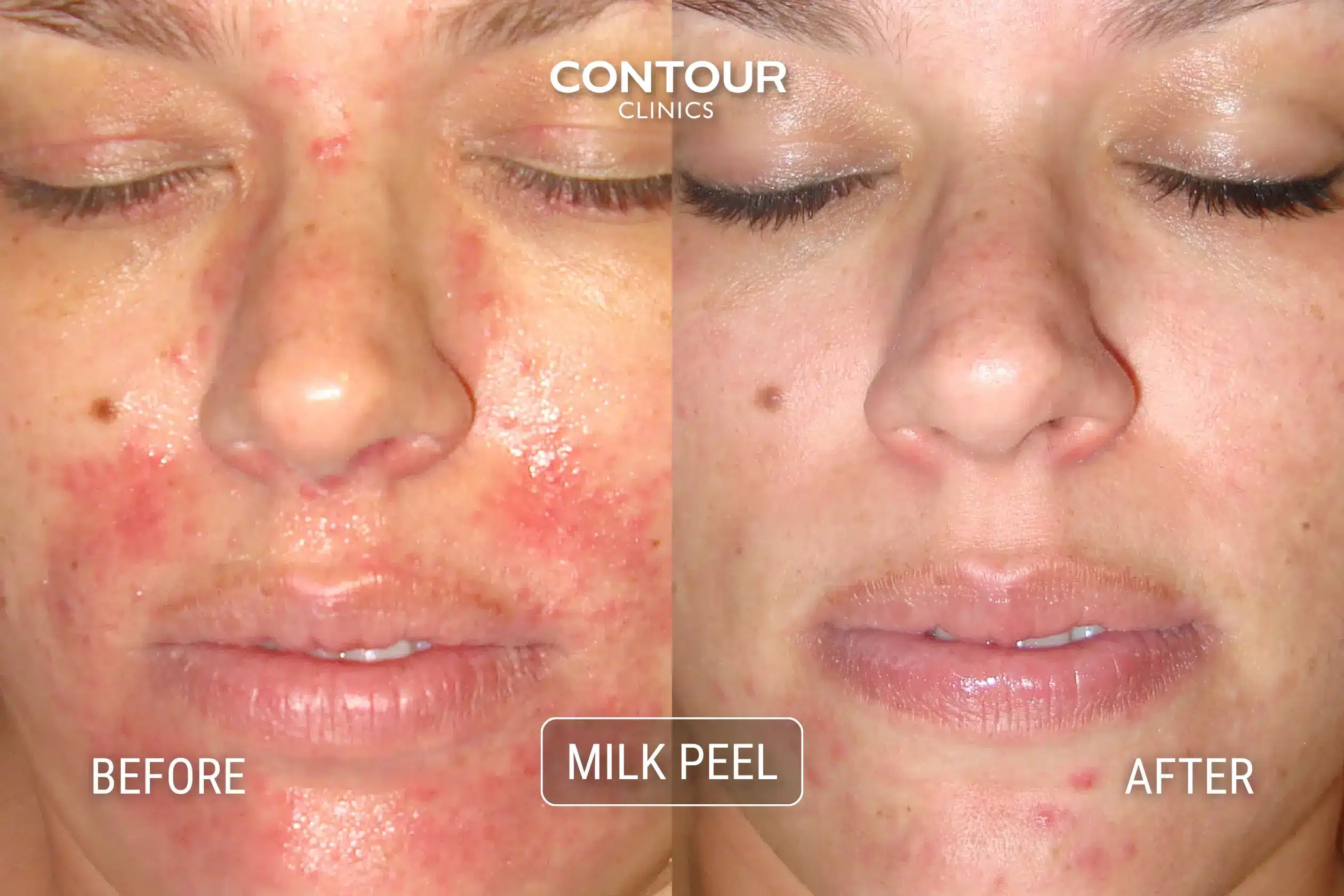 MIlk Peel Before and After image