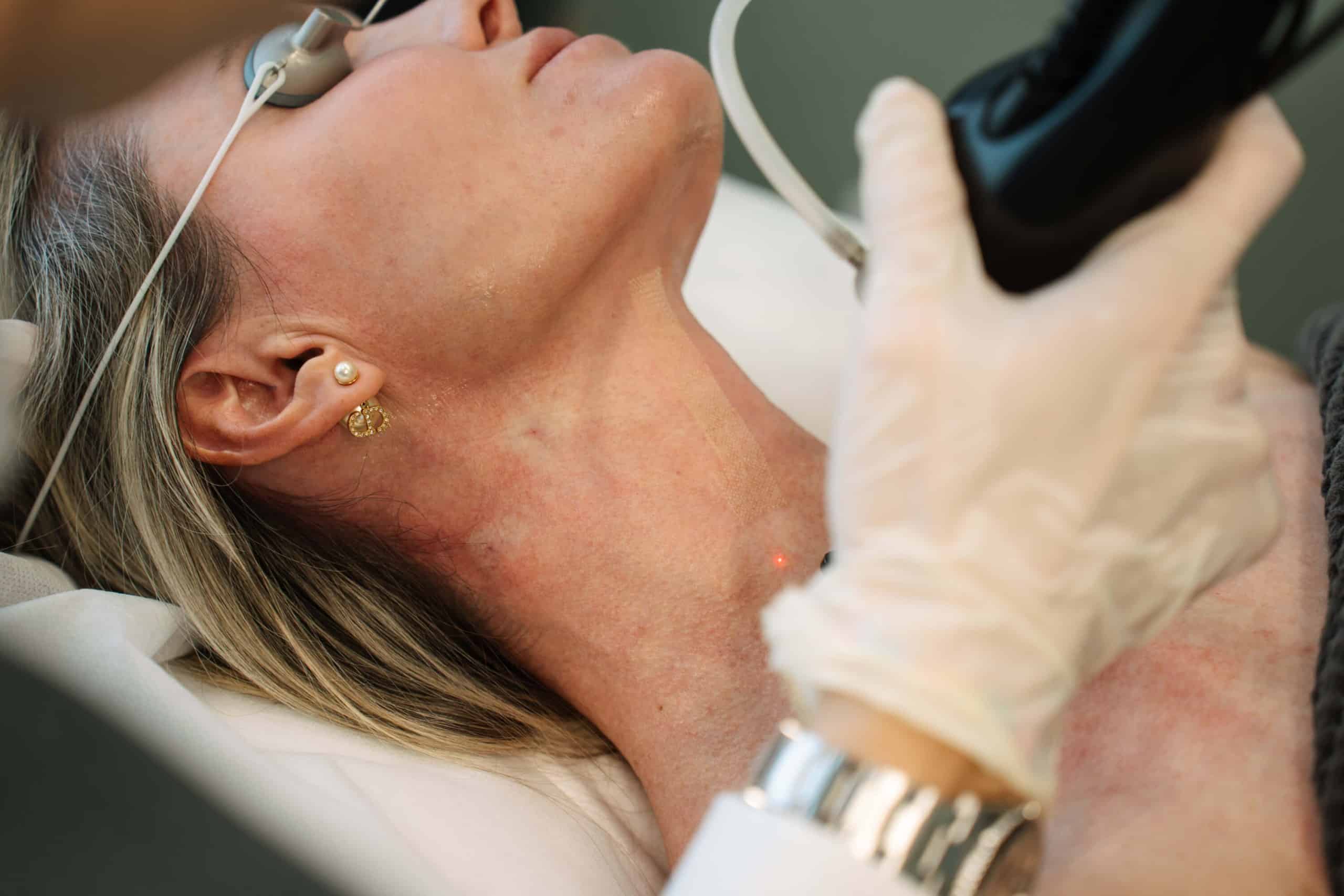 Non-Surgical Approaches to Ozempic Neck include skin tightening