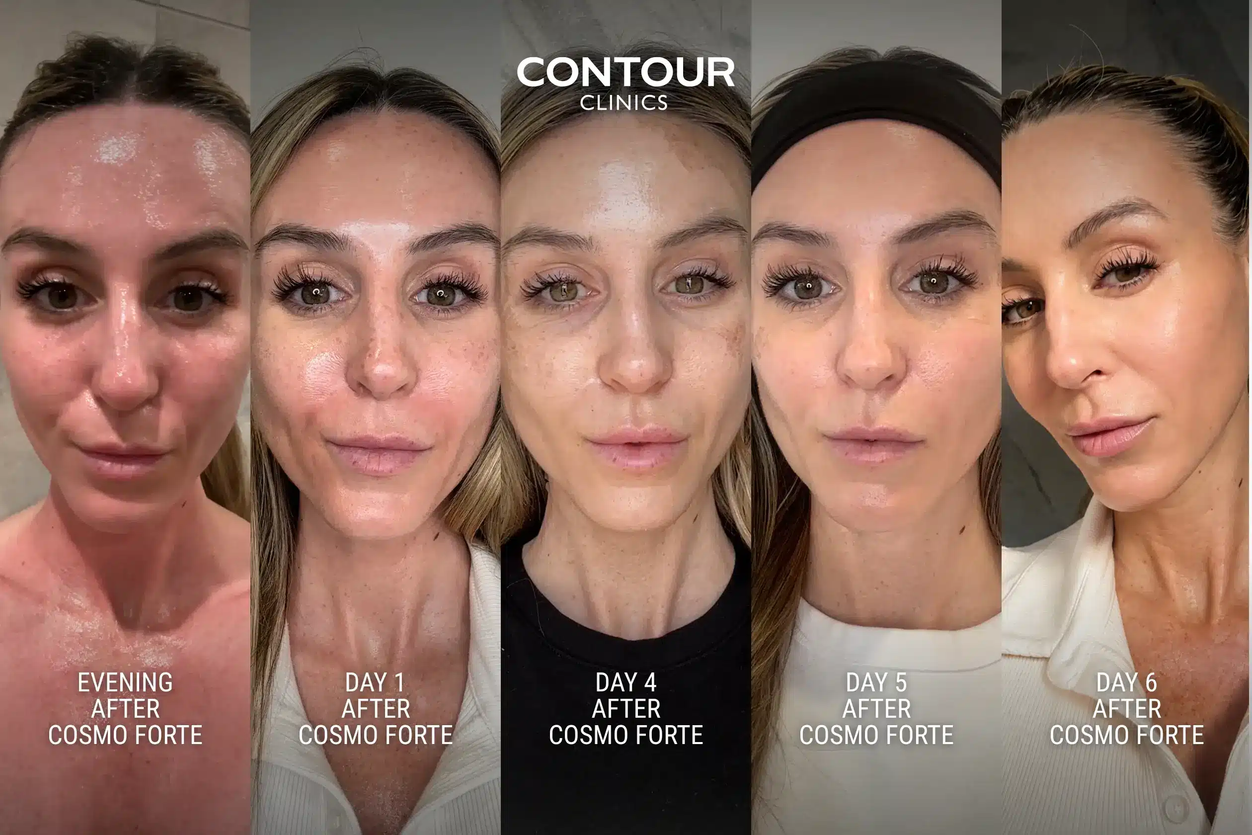 Recovery journey and downtime after a TCA Chemical Peel (cosmo peel) at Contour Clinics Sydney and Brisbane