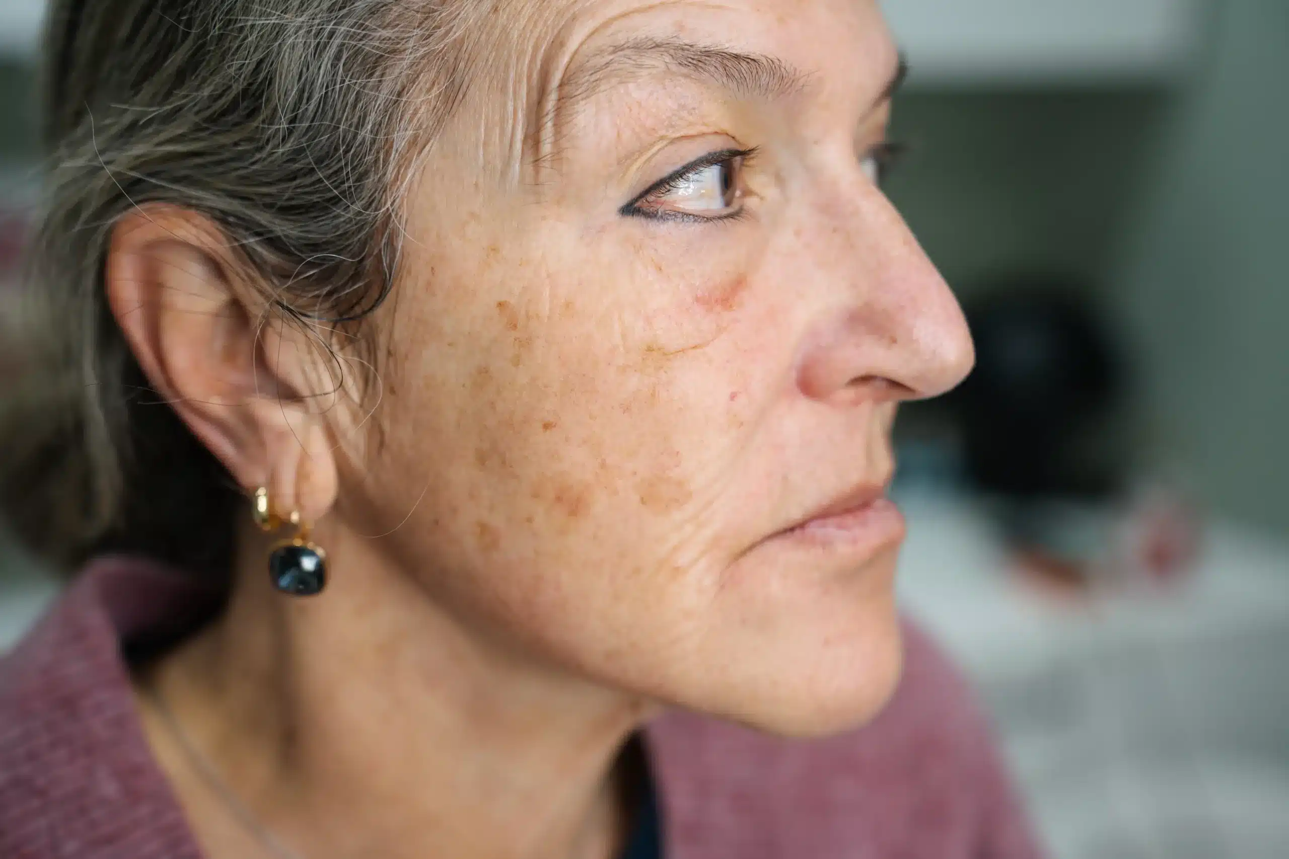 TCA chemical peel can help with deep pigmentation and fine lines