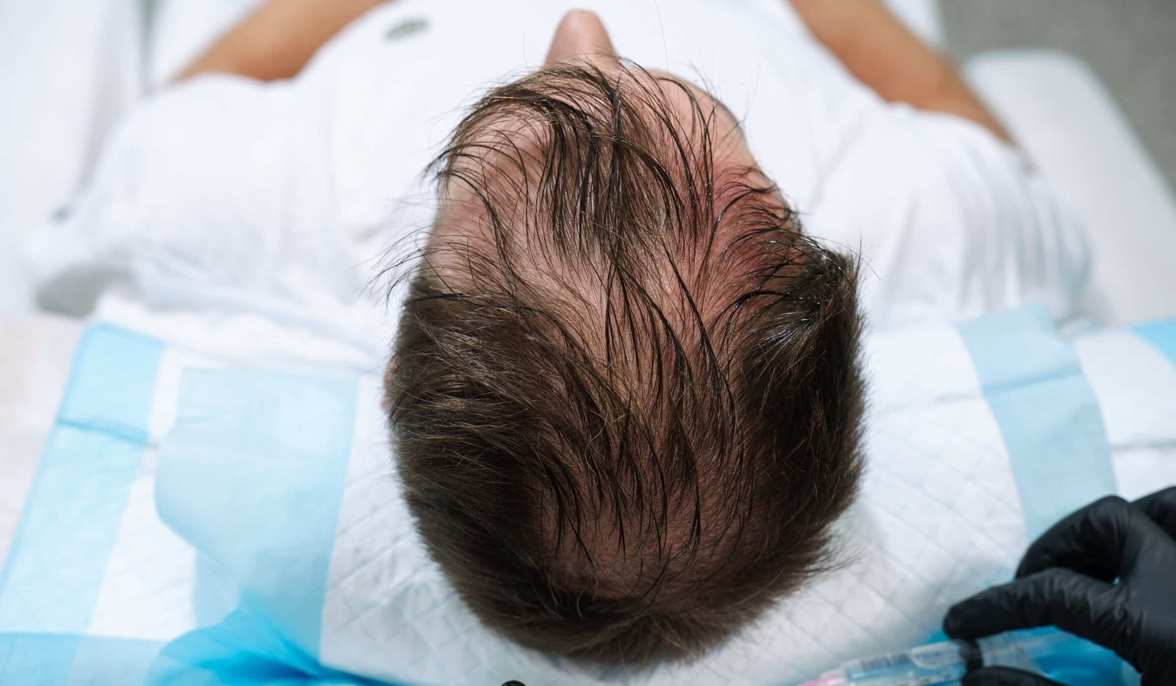 Hair Shedding or Hair Thinning? How the Hair Growth Cycle Explains the Difference