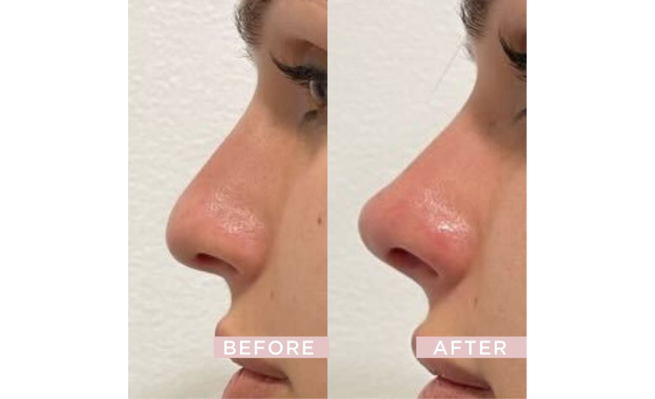 Nose Tip Lift Filler, Non-Surgical Lifting