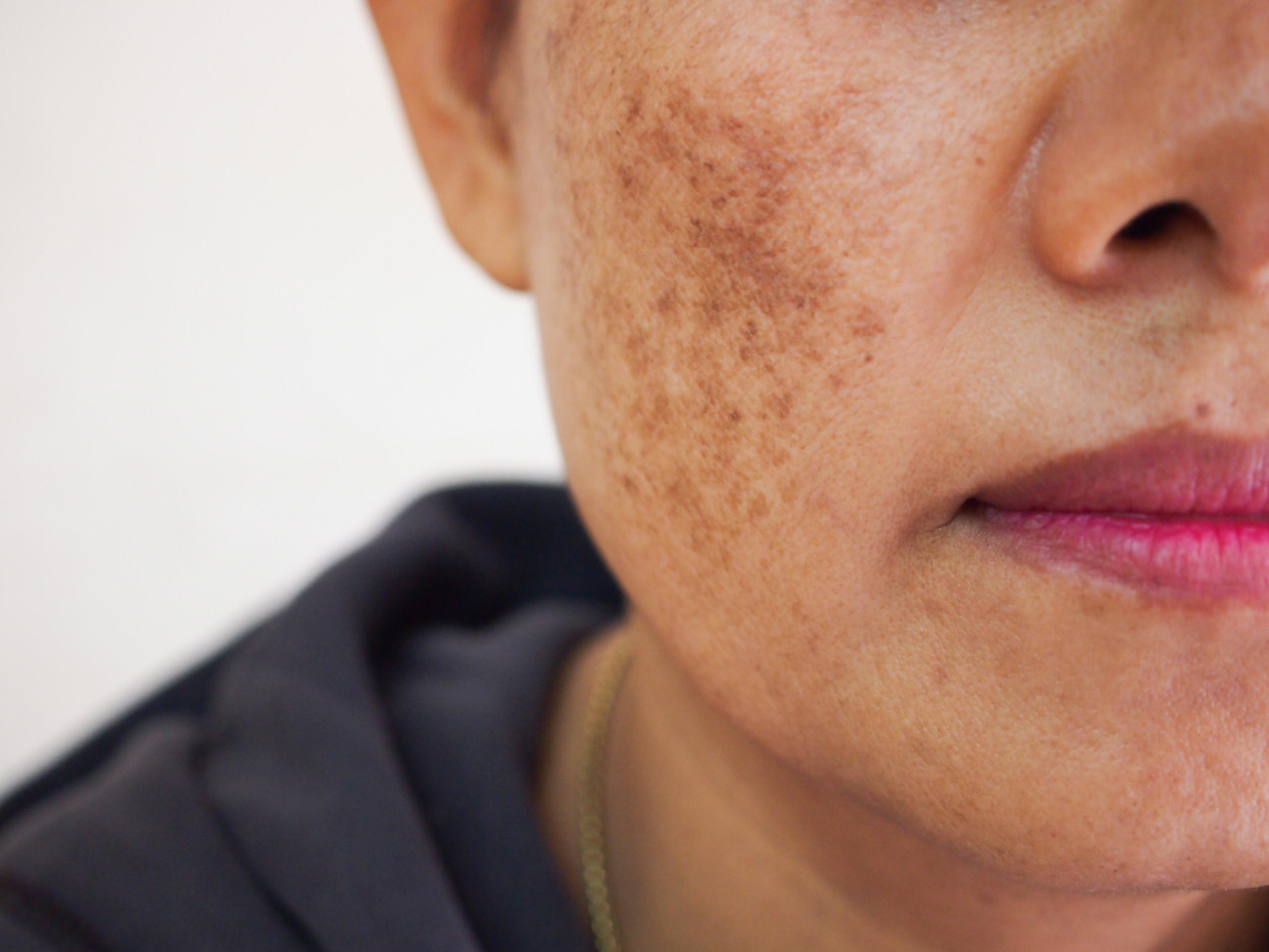 Cosmelan peel in Sydney to target pigmentation and melasma