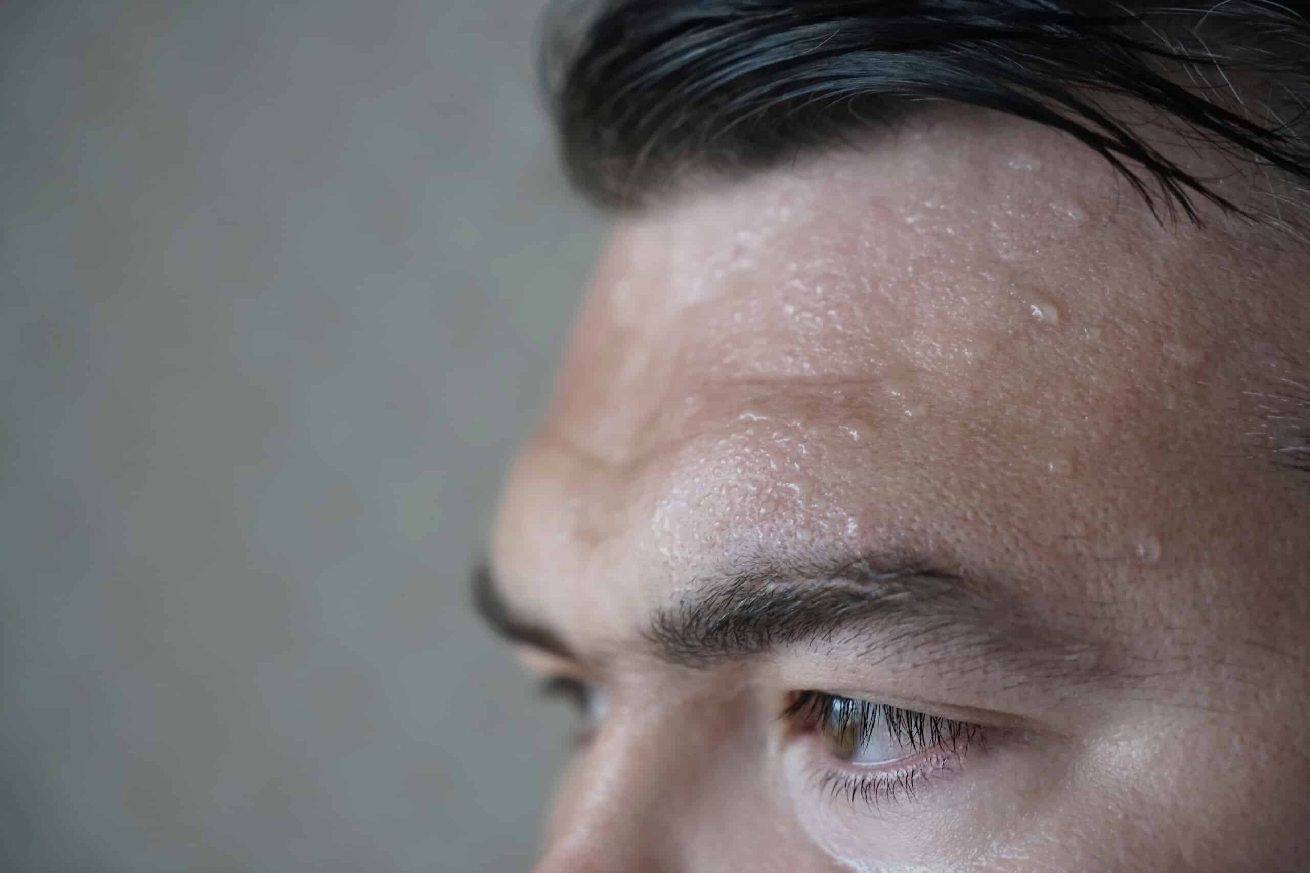 Excessive Sweating Face Excessive Sweating Face