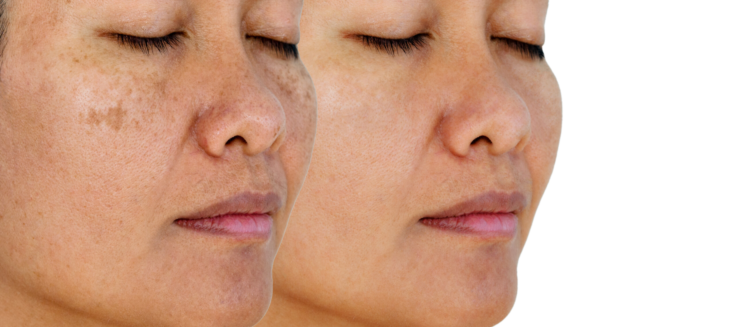 Melasma and Aging: Navigating Changes in Skin Pigmentation Over Time