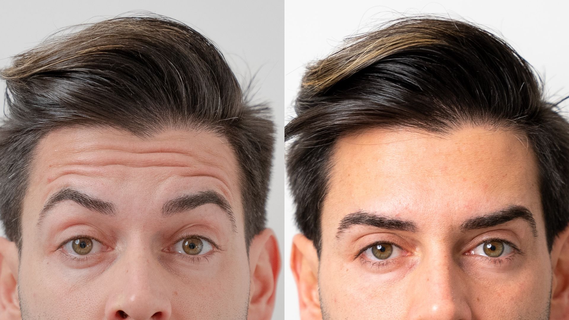 Anti-Wrinkle Before and After Gallery