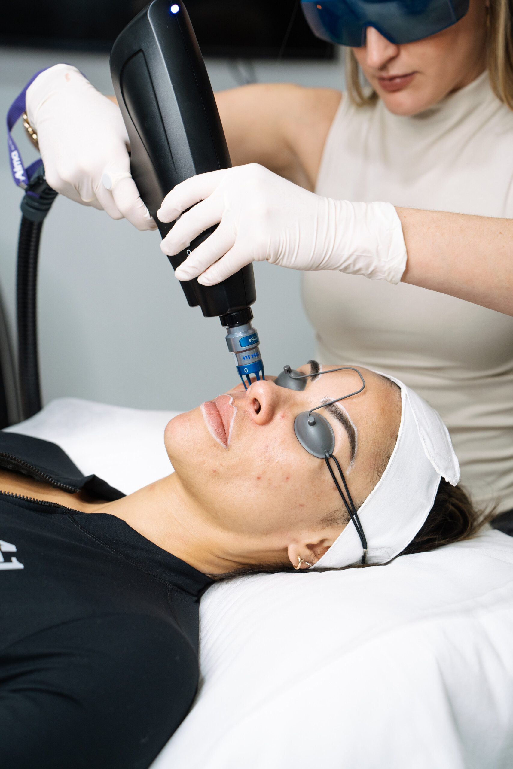 Laser capillary removal sydney