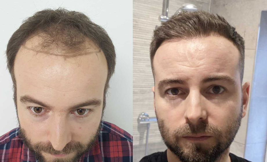 Hair Transplant Sydney | Hair Restoration Surgery | Contour Clinics