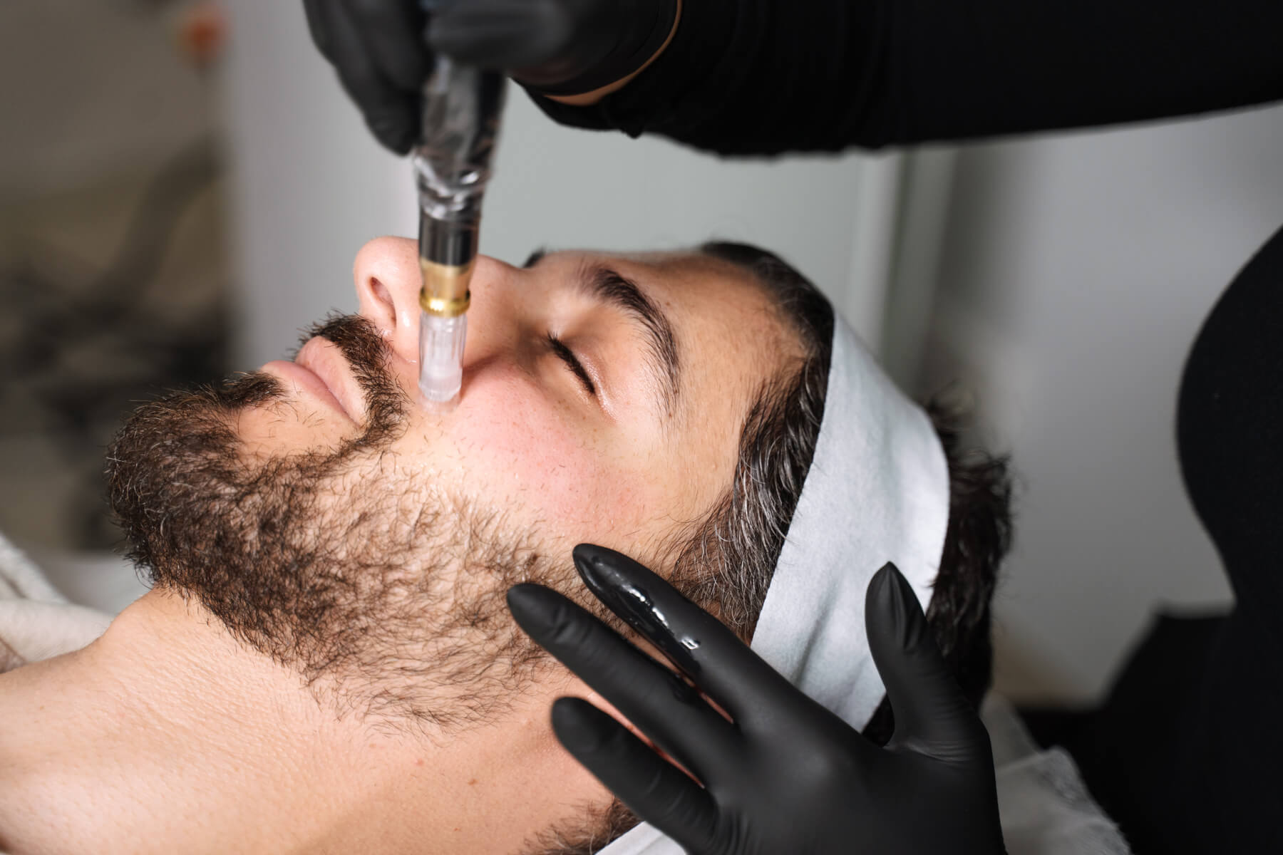 Skin needling for anti-wrinkle treatment at Contour Clinics in Sydney and Brisbane