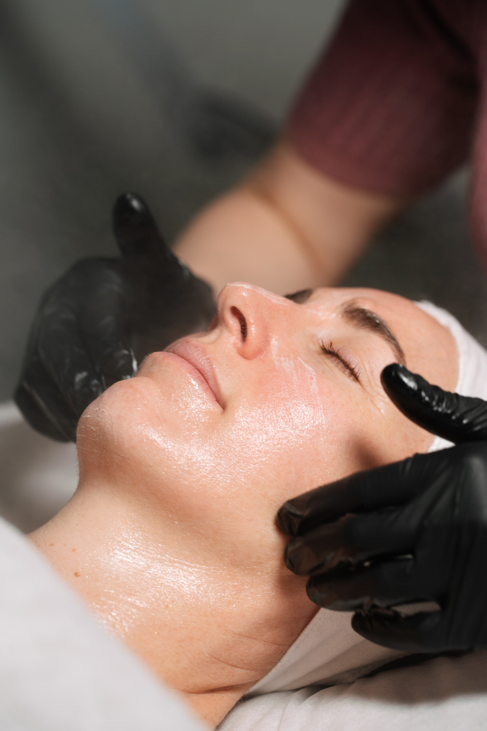 Dermamelan peel sydney
