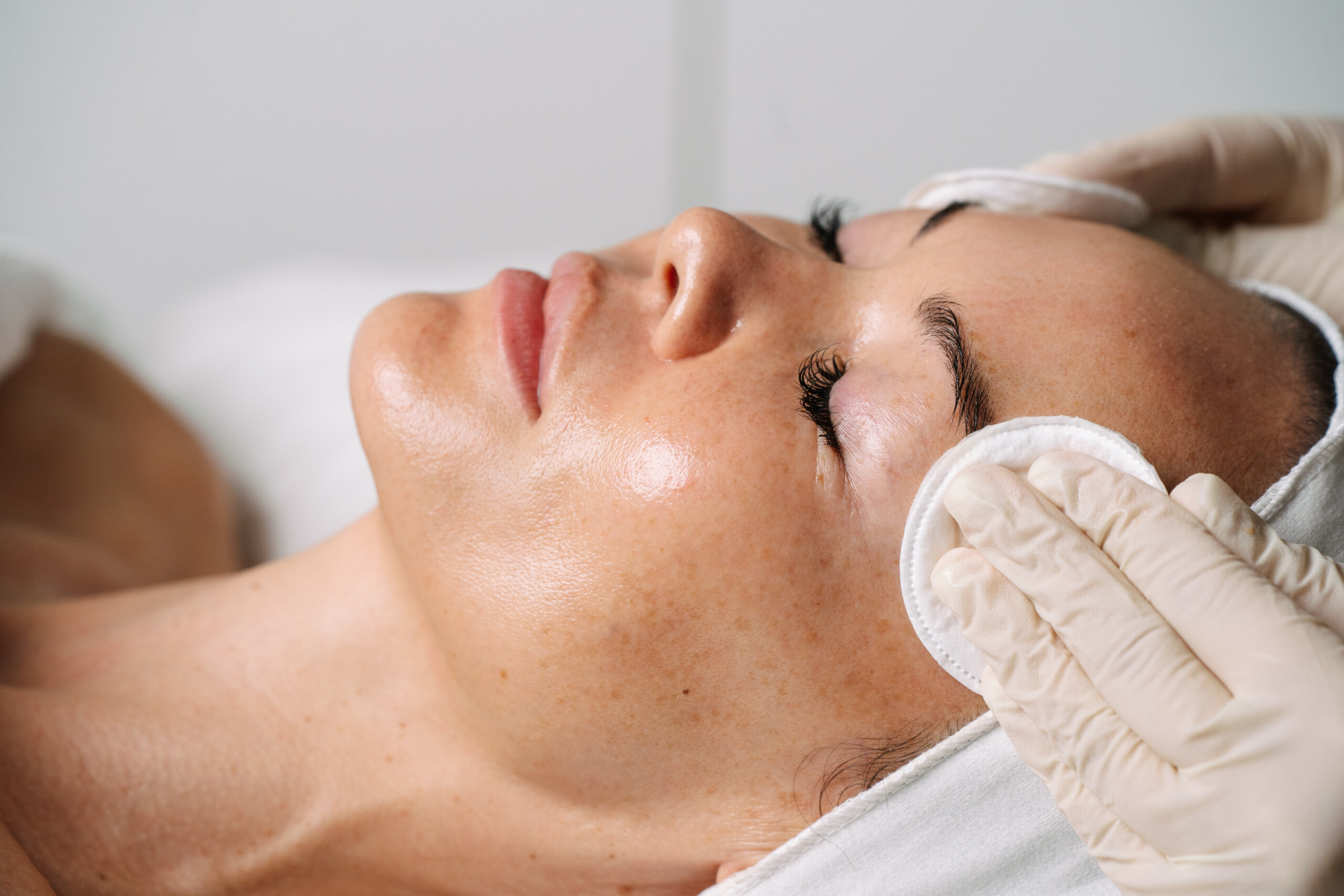 Cosmelan peel before and after