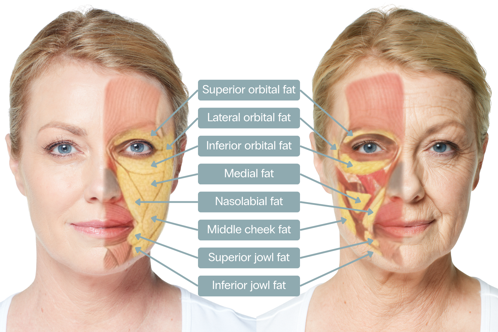 Facial fat pads