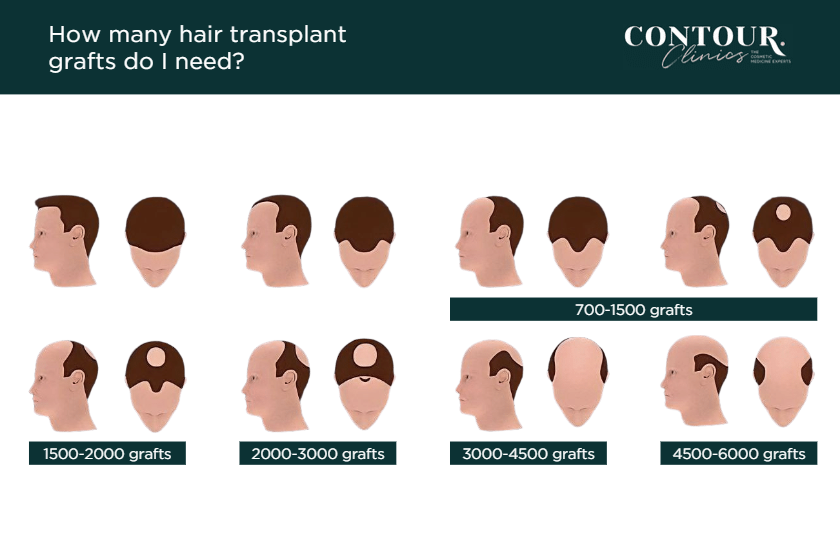 Hair Transplant Sydney | Hair Restoration Surgery | Contour Clinics