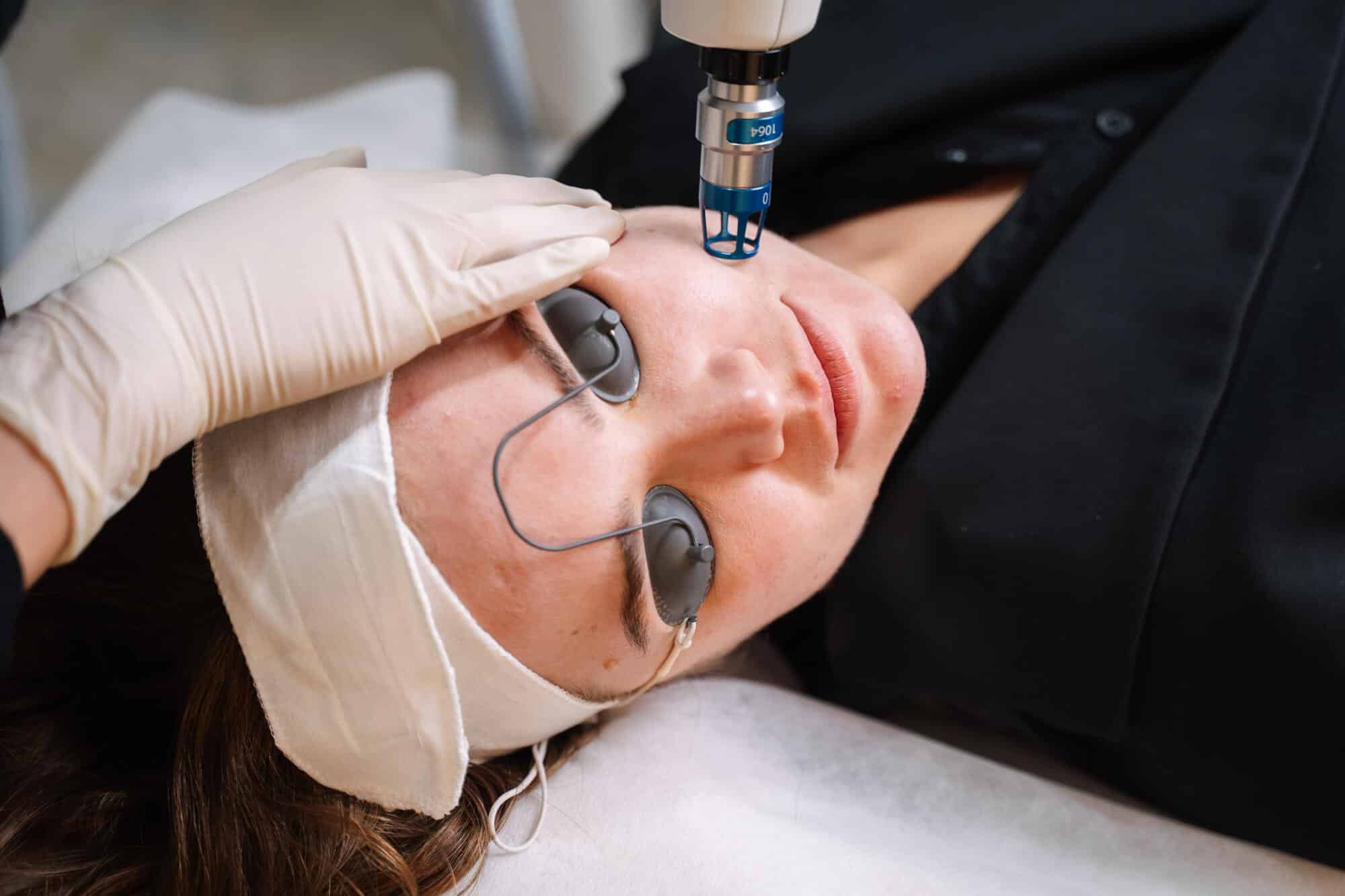 Laser treatment for broken capillaries removal