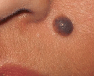 mole on face