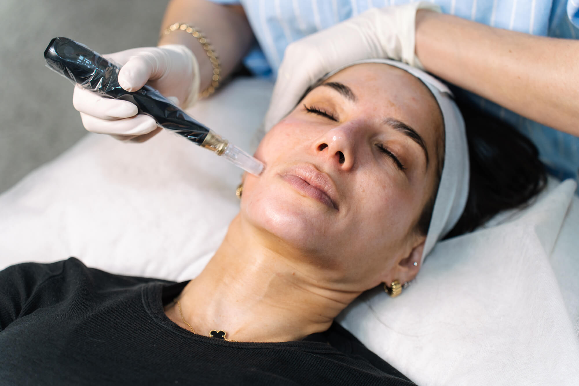Morpheus8 Radio-Frequency Skin Needling