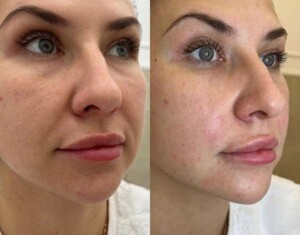 PDO Threads Before and After Gallery | Contour Clinics