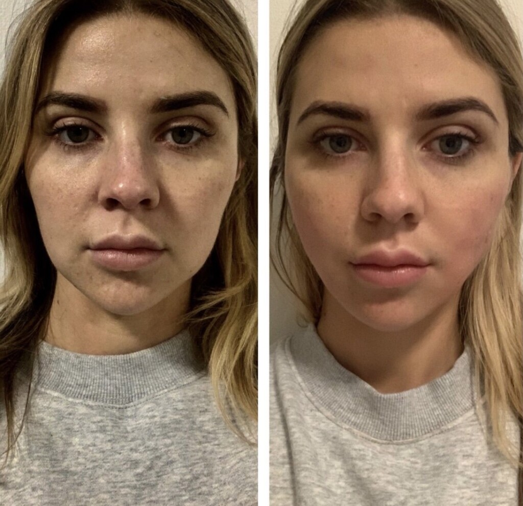 PDO Threads Before and After Gallery Contour Clinics