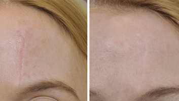 scarring skin needling