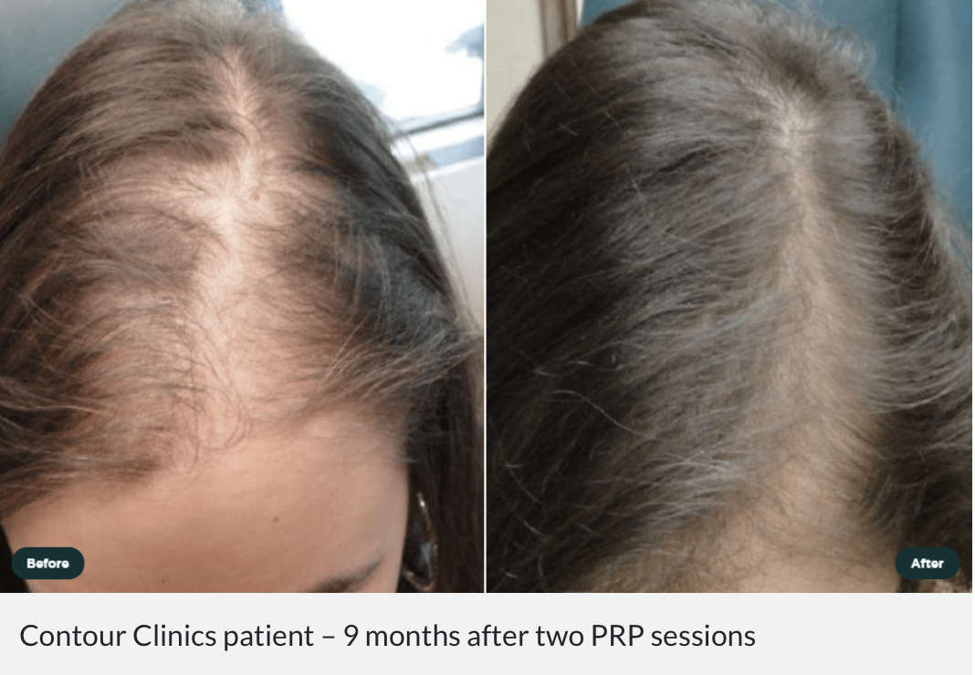 Dr Josh Wall talks to Spa+Clinic about PRP for Hair Loss - Contour Cosmetic  Clinics