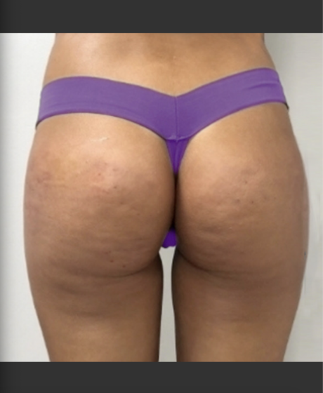 Sculpting Sensuality: The Brazilian Buttock Lift Unveiled