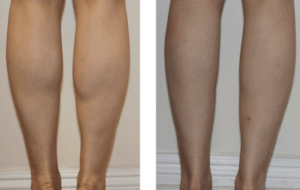 Calf slimming before and after
