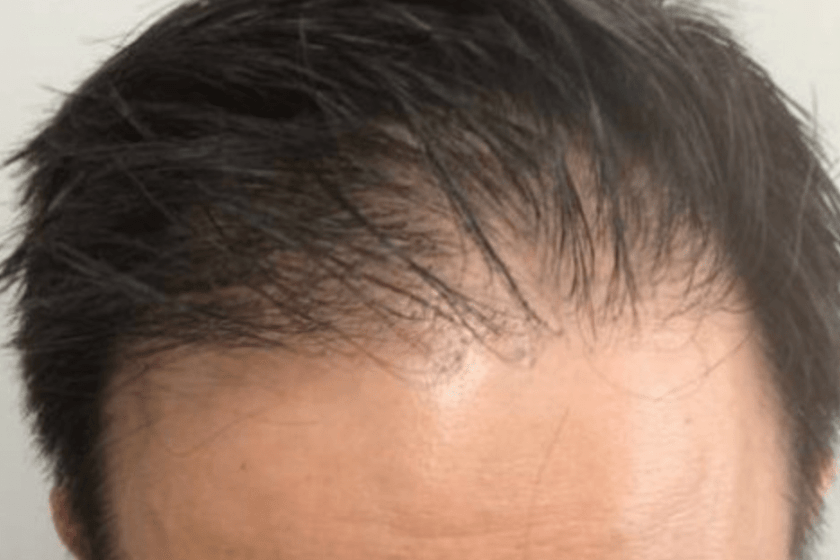 How Exosomes Work for Hair Loss