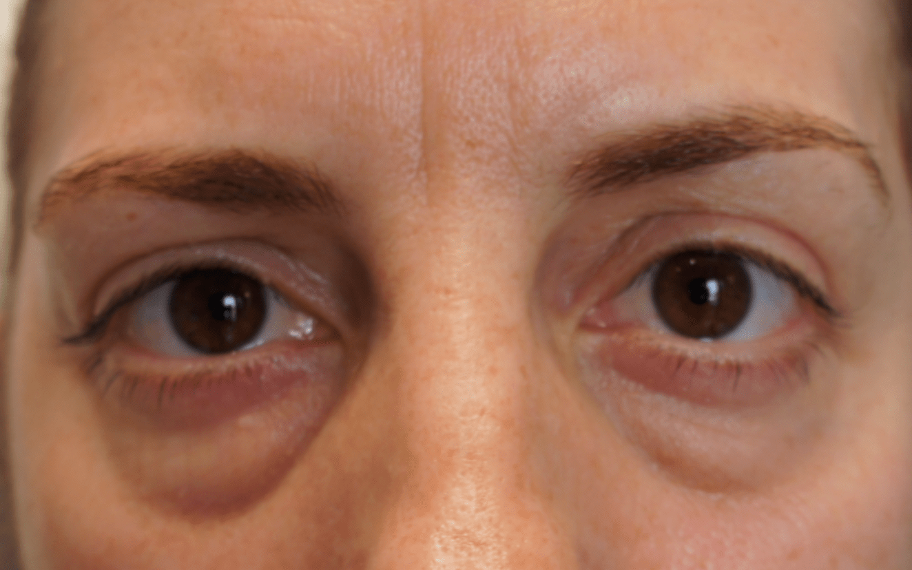 Лечение мешков под глазами у мужчин. Мешки под глазами. Впавшие глаза.