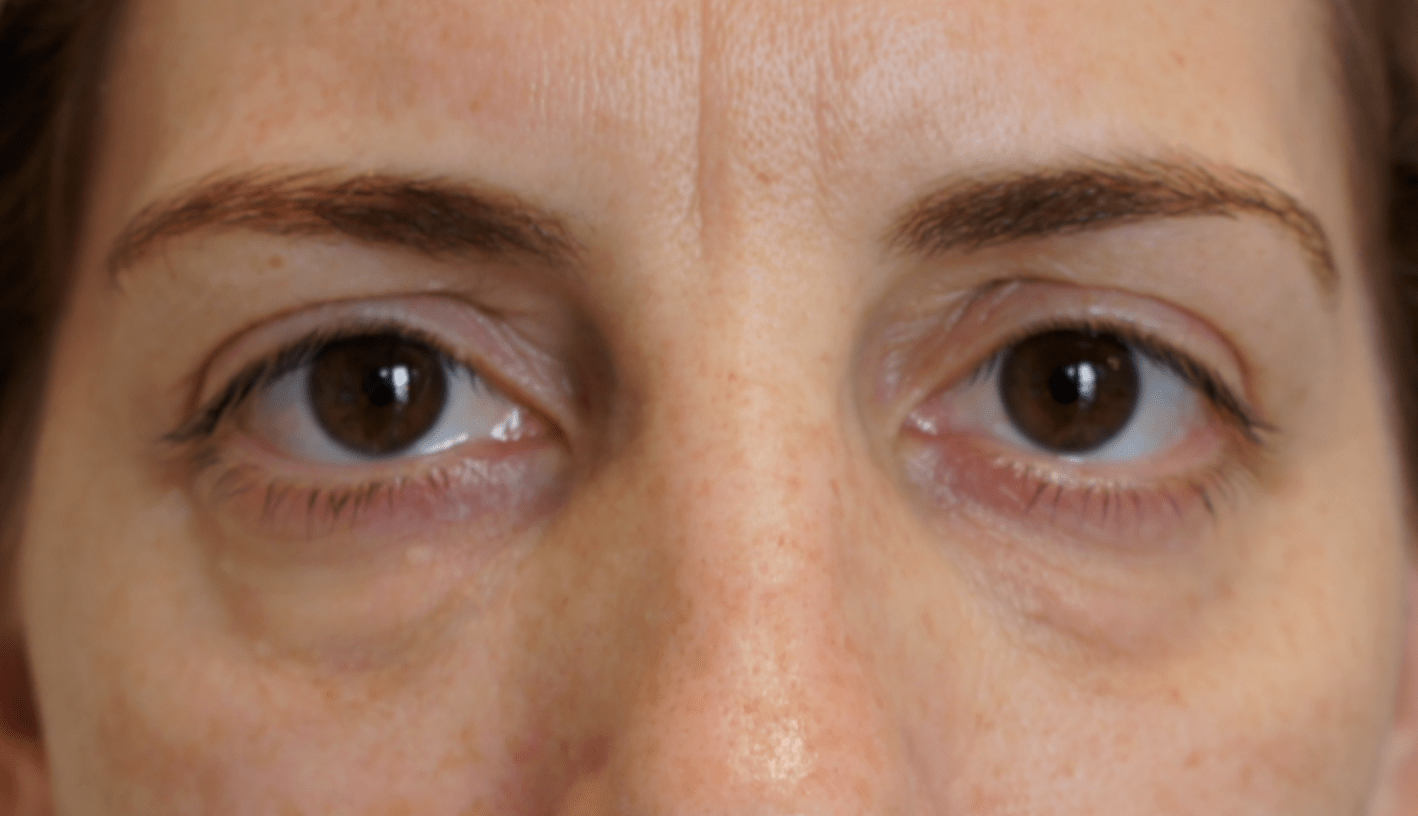 Причина припухлости под глазами у женщин. Новообразование нижнего века. Причина припухлости под глазами у женщин. Припухлость под левым глазом. Причина припухлости под глазами у женщин.